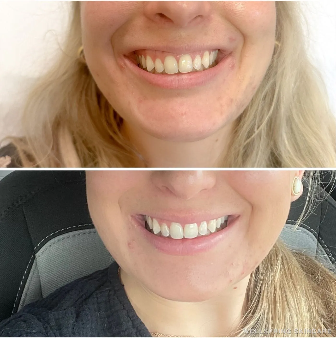 Before and after: Gummy smile treated with Botox