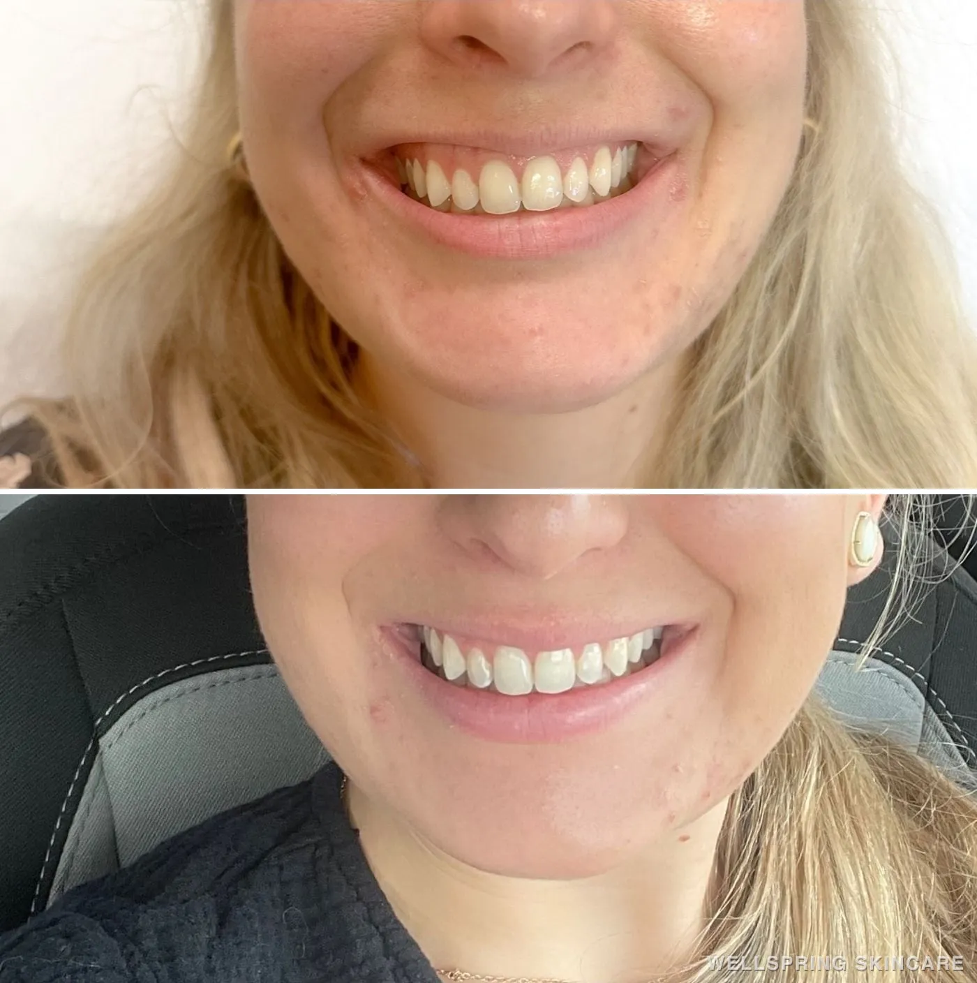 Before and after: Gummy smile treated with Botox