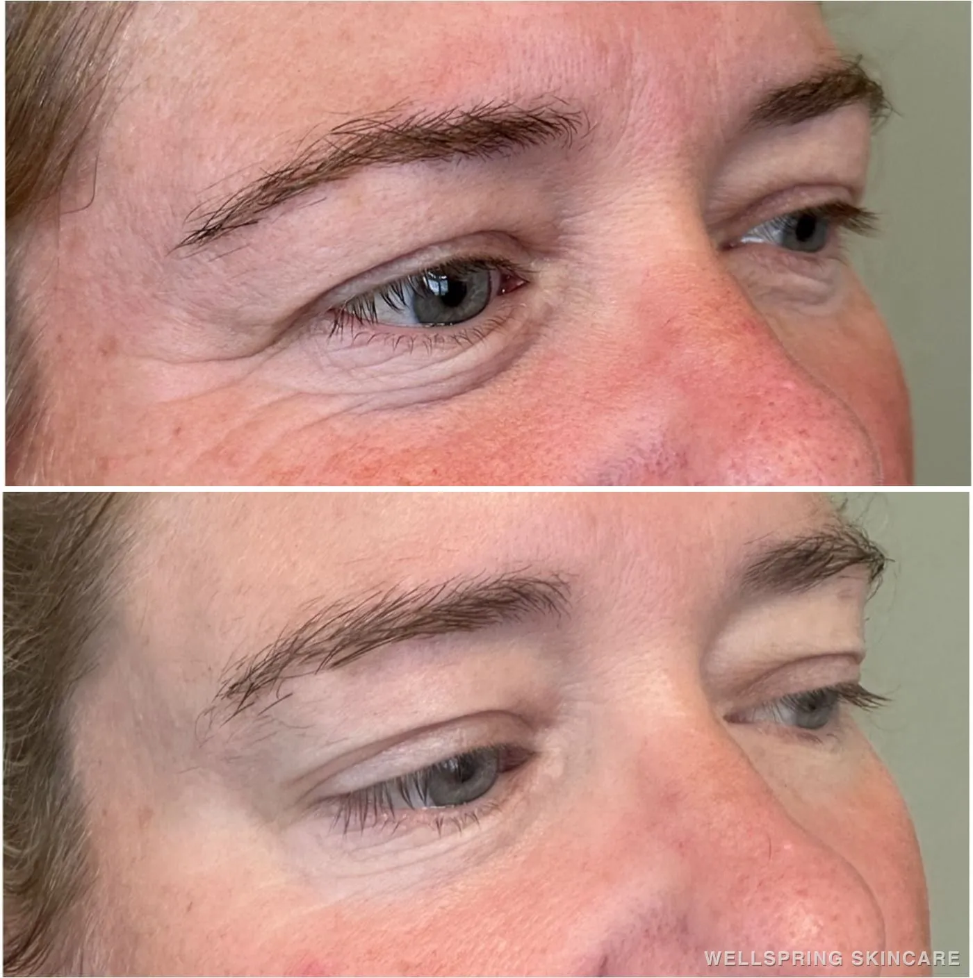 Before and after: Crow's feet wrinkles softened with Botox