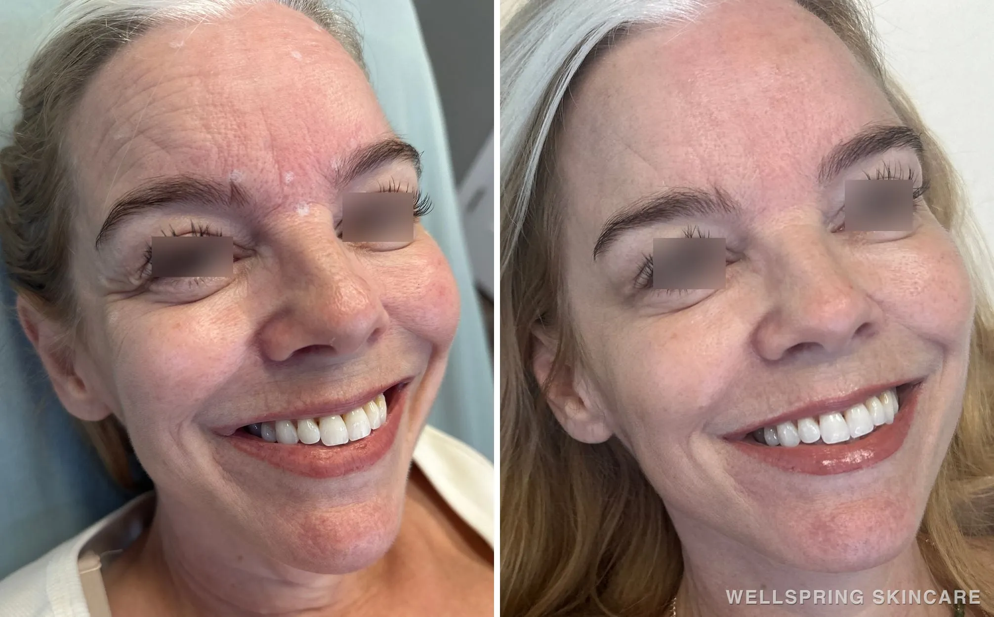 Before and after: Crow's feet & forehead lines treated with Botox