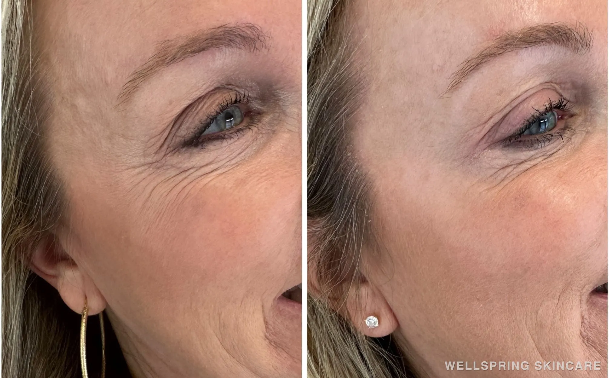 Before and after: Crow's feet lines treated with Botox