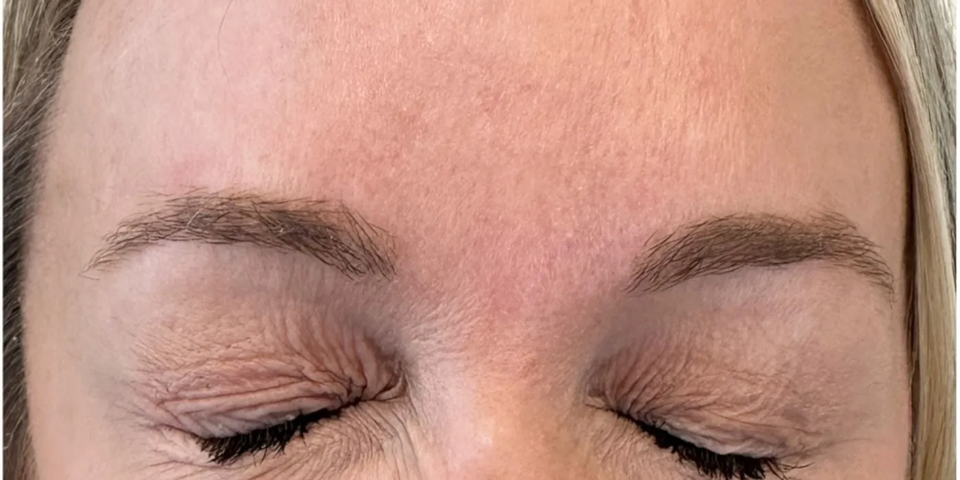 After: Forehead lines treated with Botox