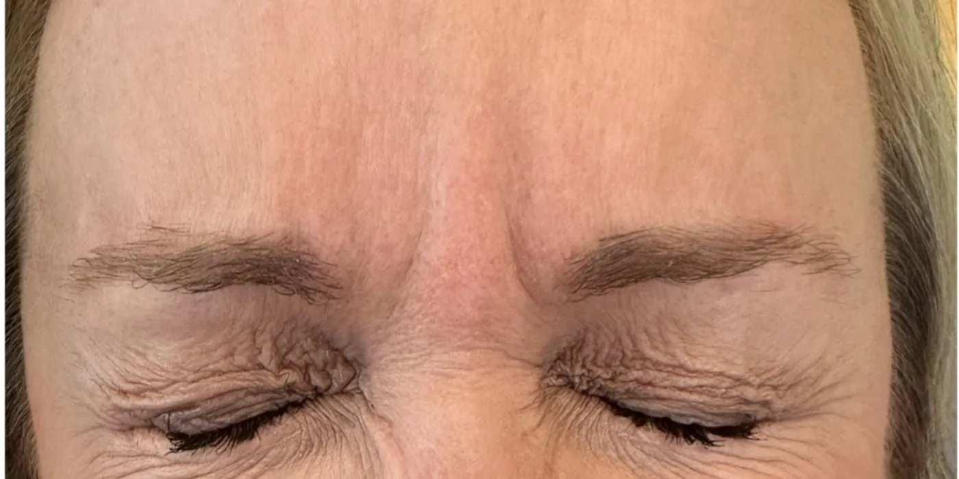 Before: Forehead lines treated with Botox