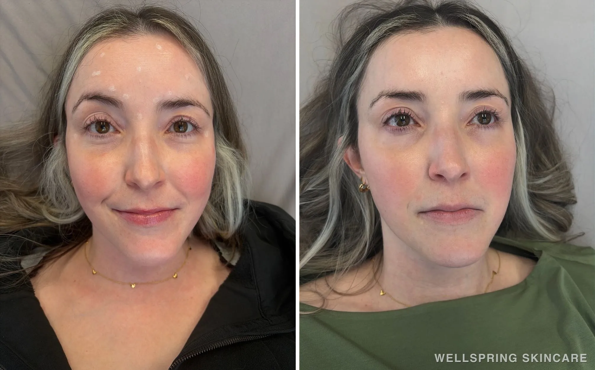 Before and after: Frown & forehead lines treated with Botox