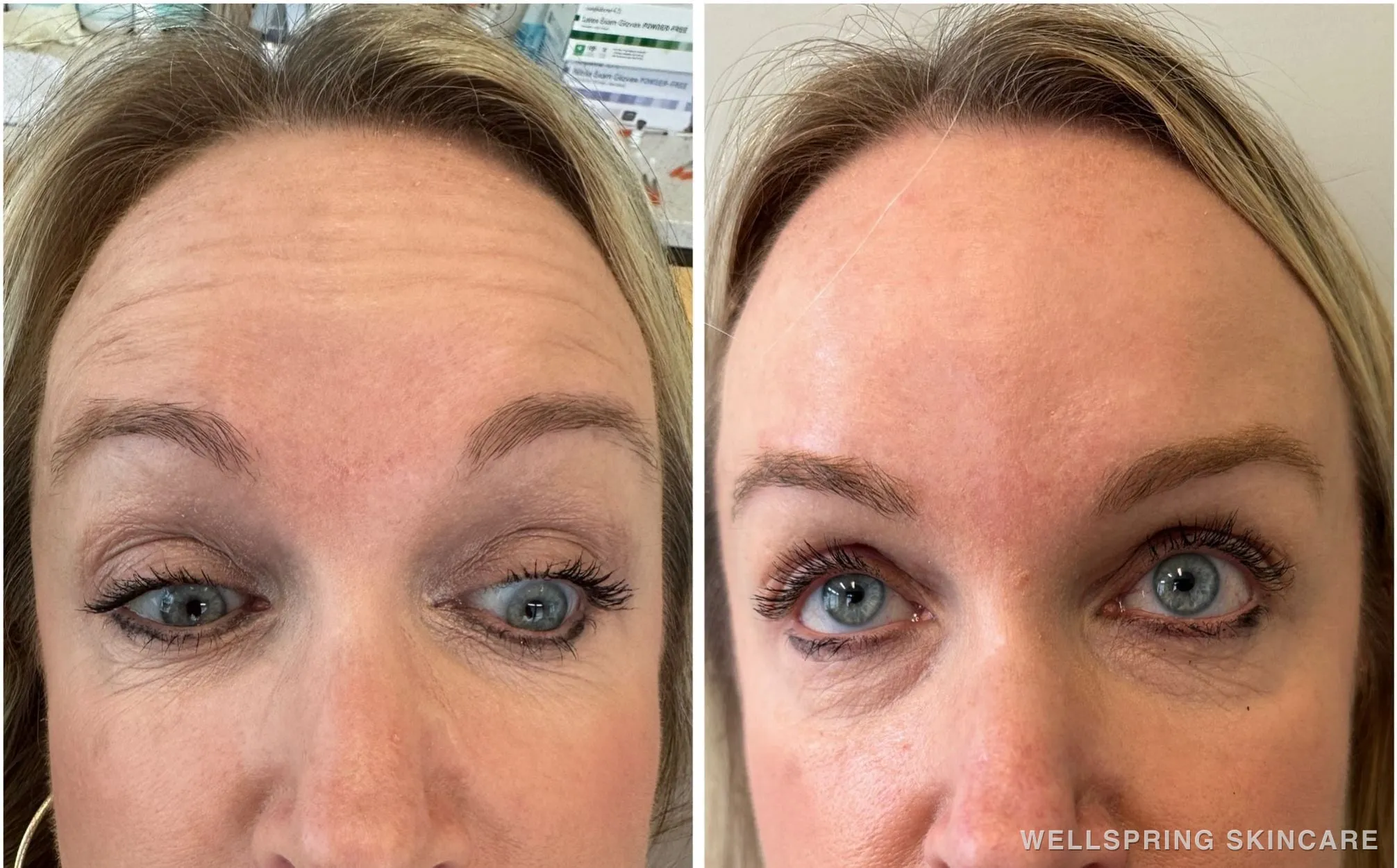 Before and after: Forehead lines treated with Botox