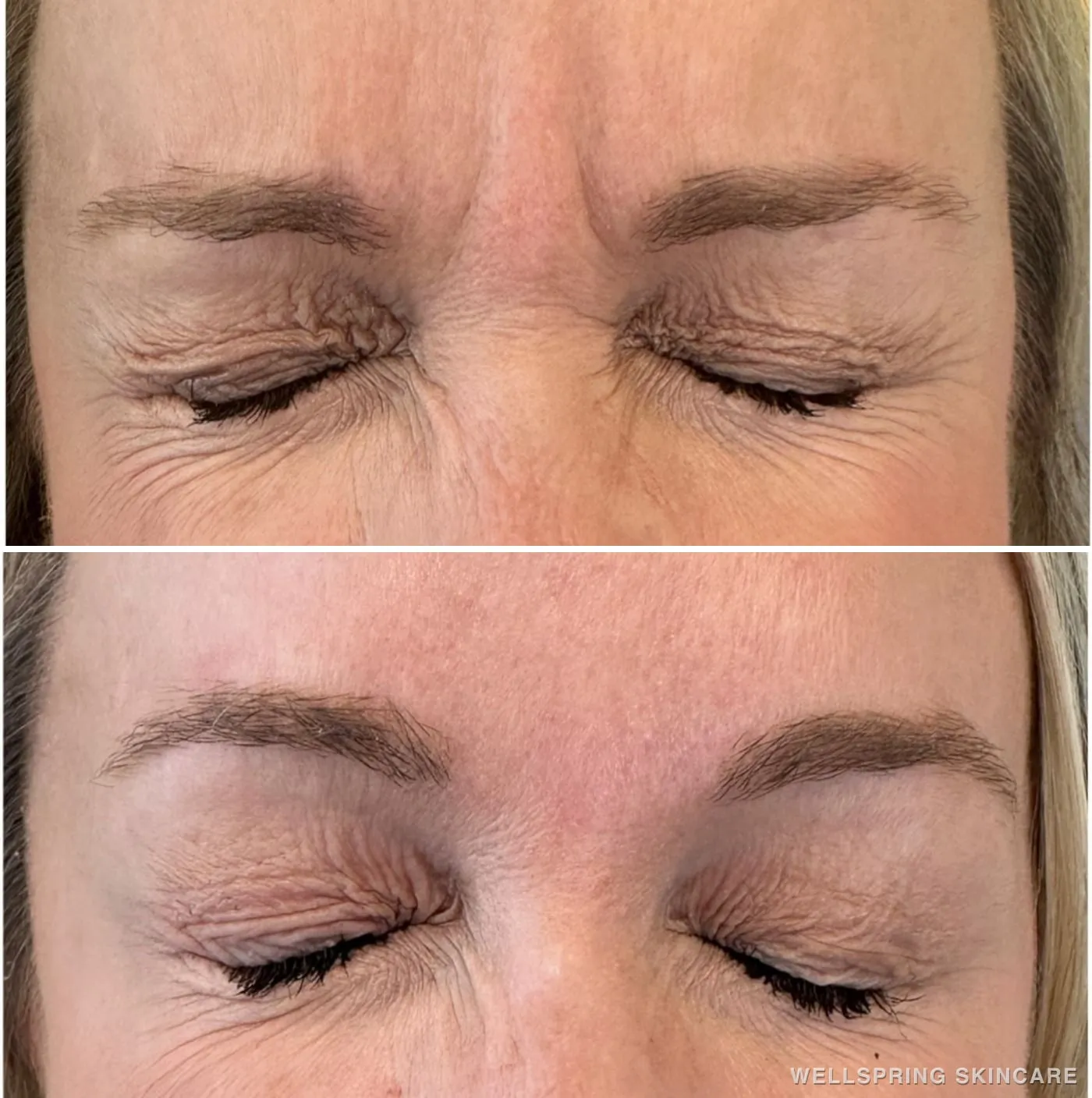 Before and after: Frown lines (the 11s) treated with Botox