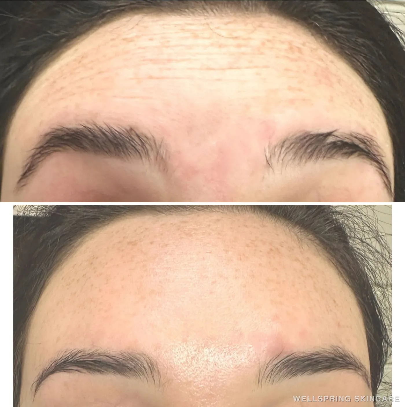 Before and after: Forehead lines smoothed with Botox
