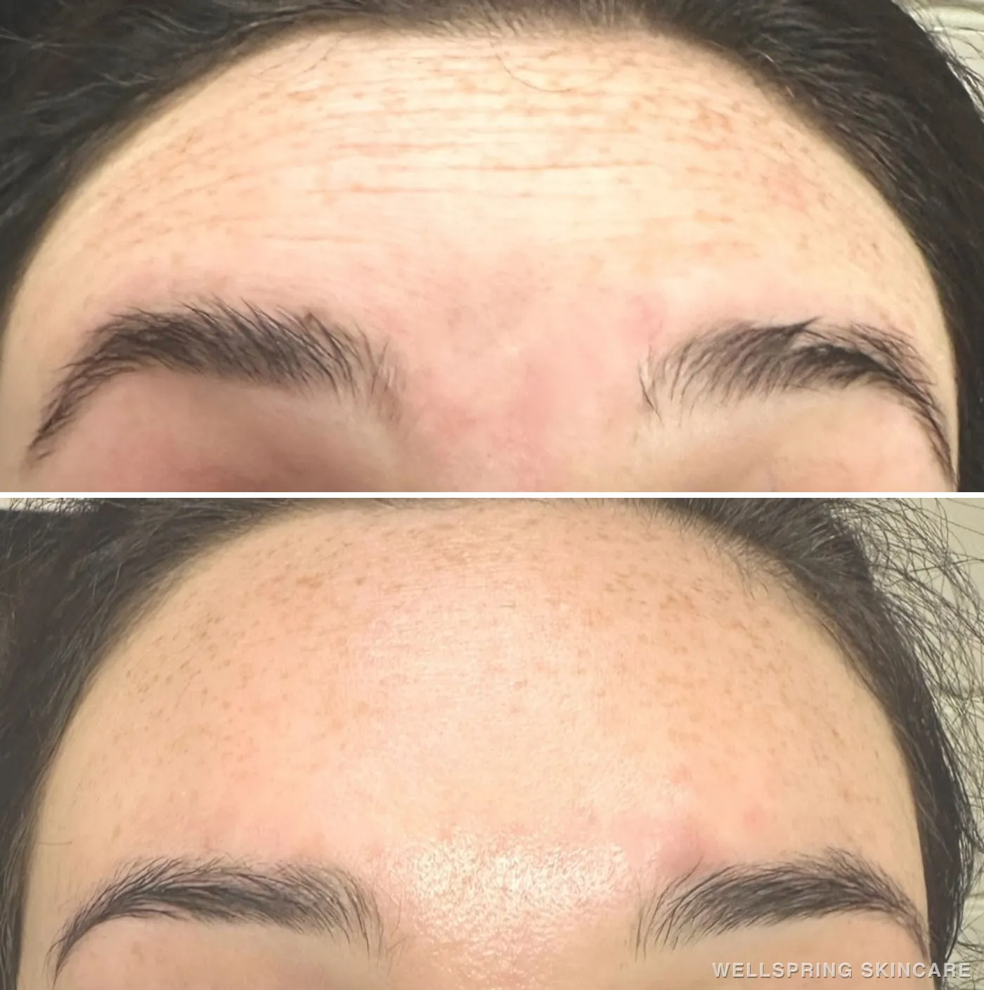 Before and after: Forehead lines smoothed with Botox