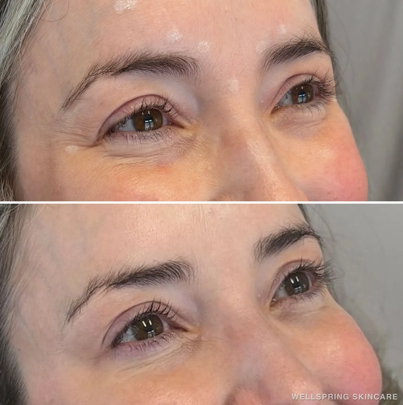 Before and after: Crow's feet & under-eye area treated with Botox