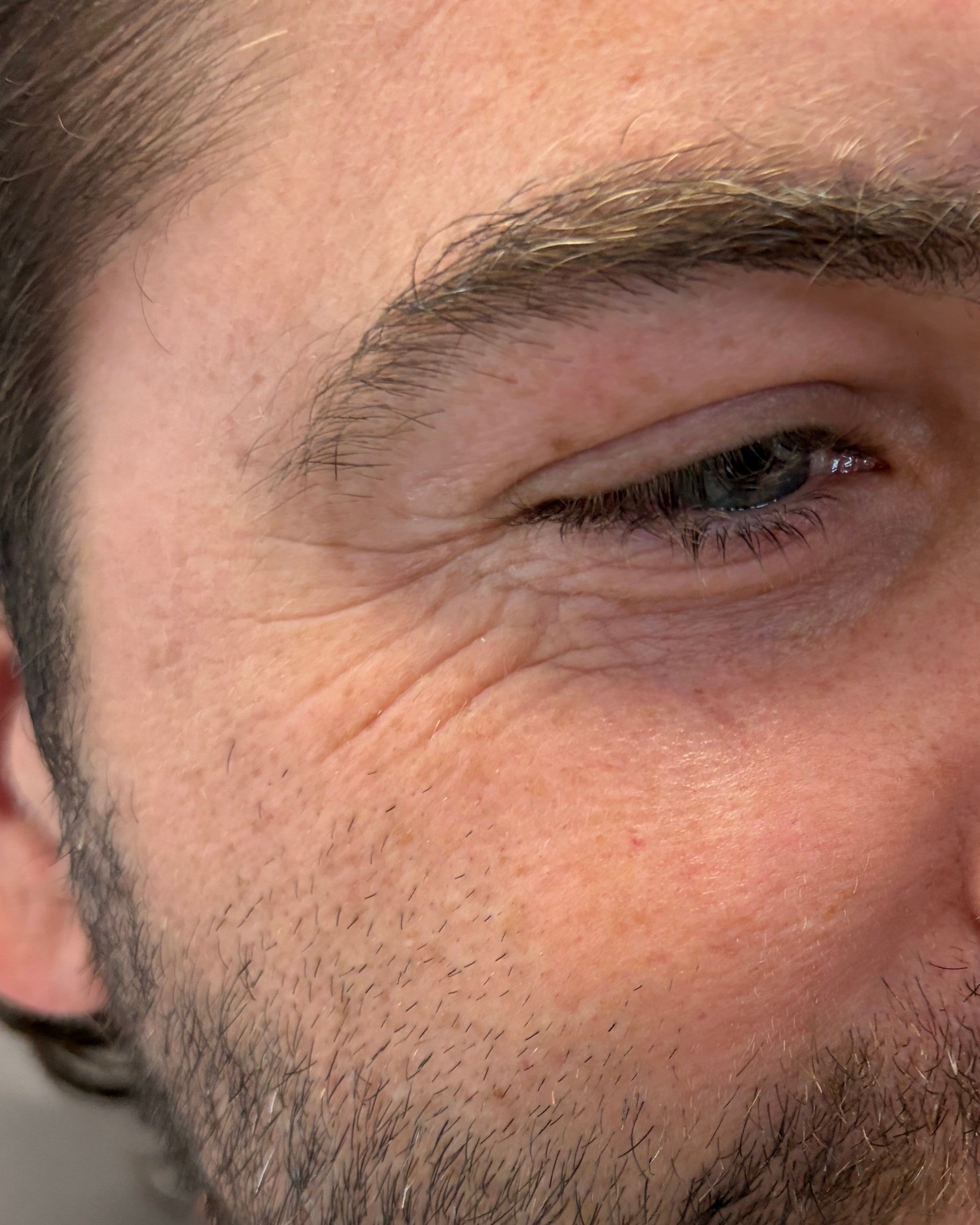 Botox treatment in progress at Wellspring Skincare in Roswell