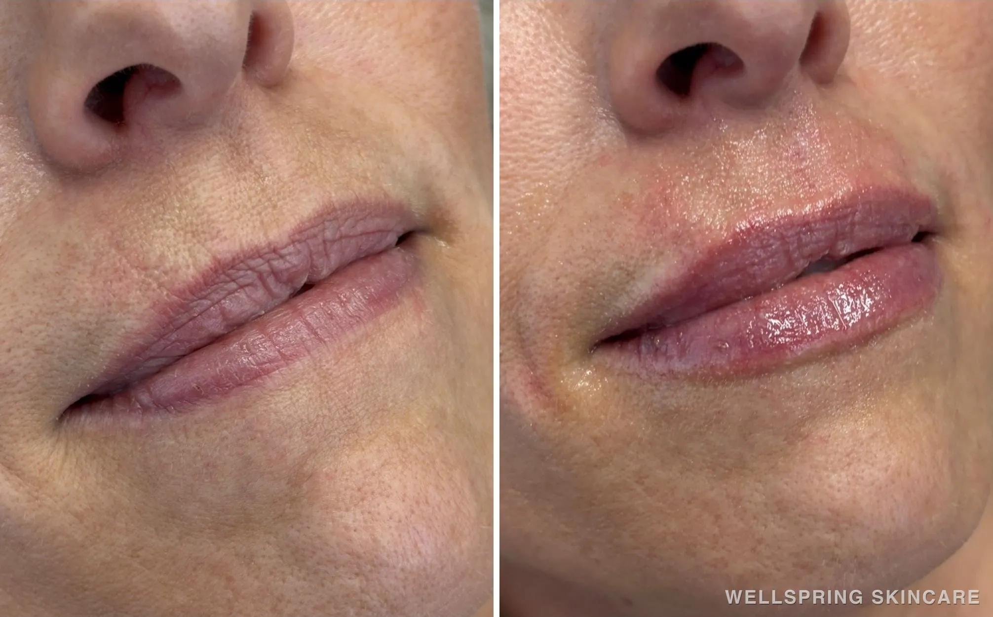 Before and after: Lip volume & shape with lip filler