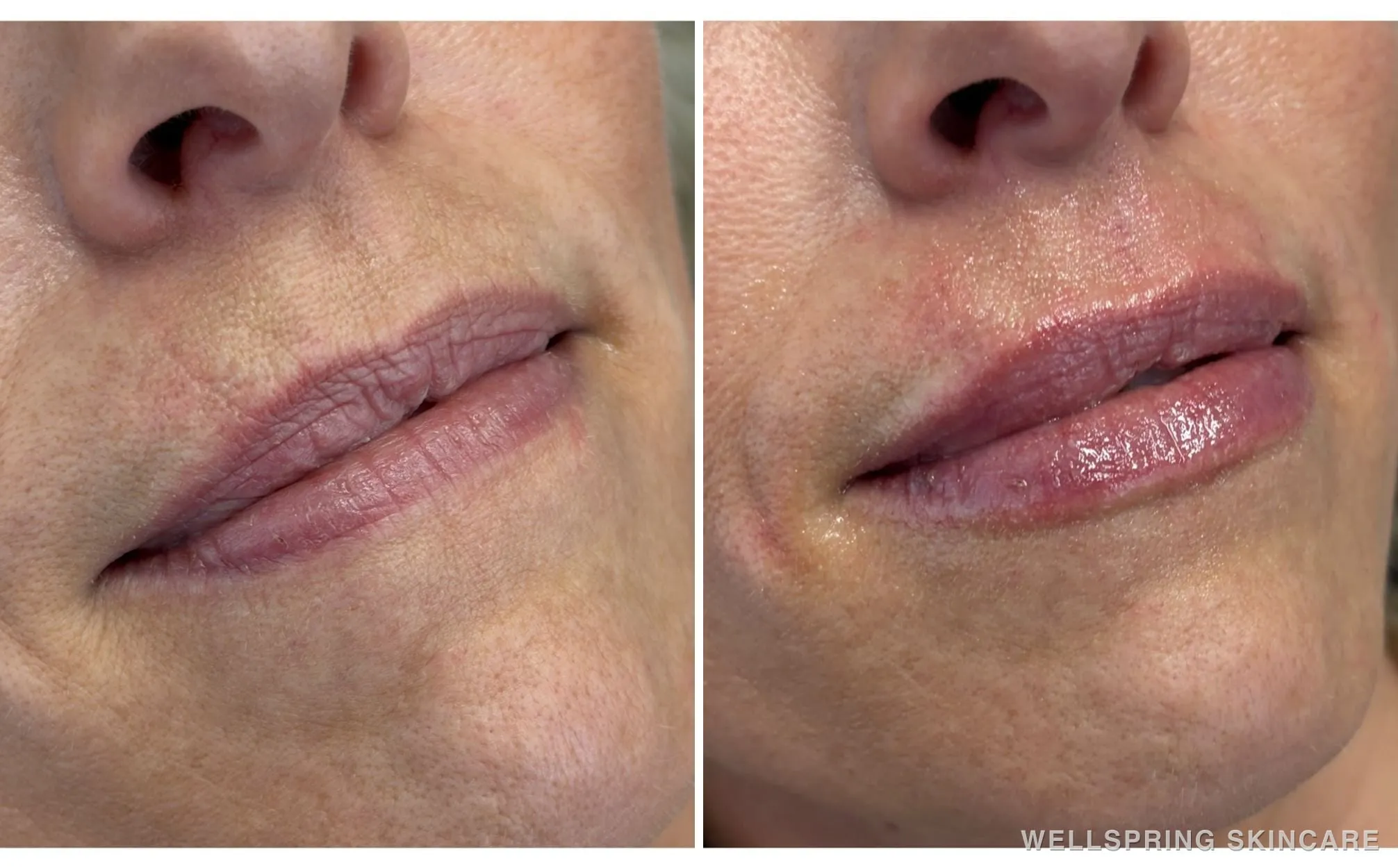 Before and after: Lip volume & shape with lip filler