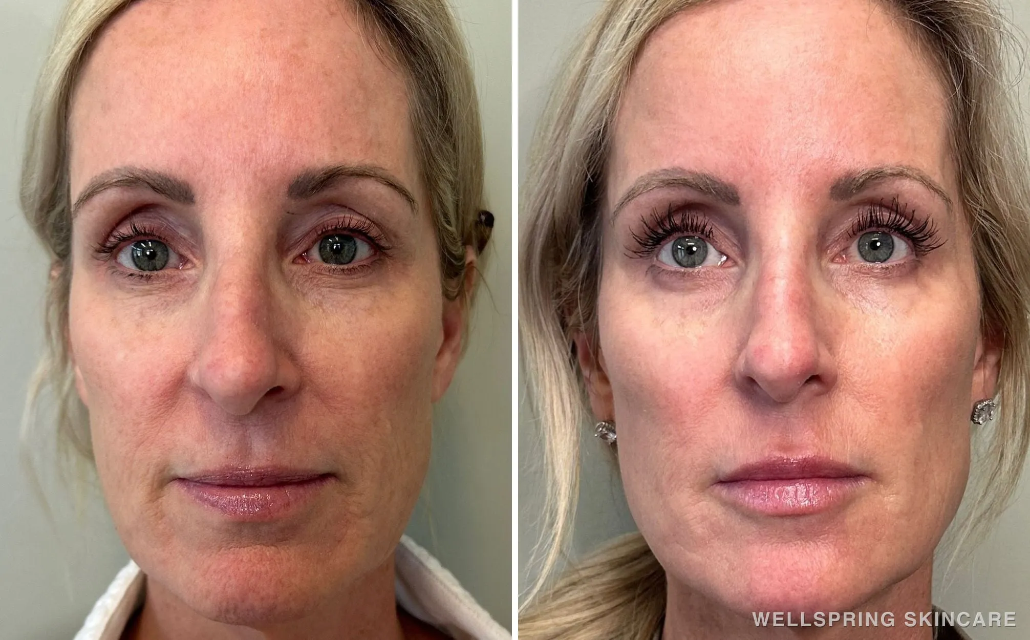 Before and after: Under-eyes, cheeks & lips treated with dermal filler