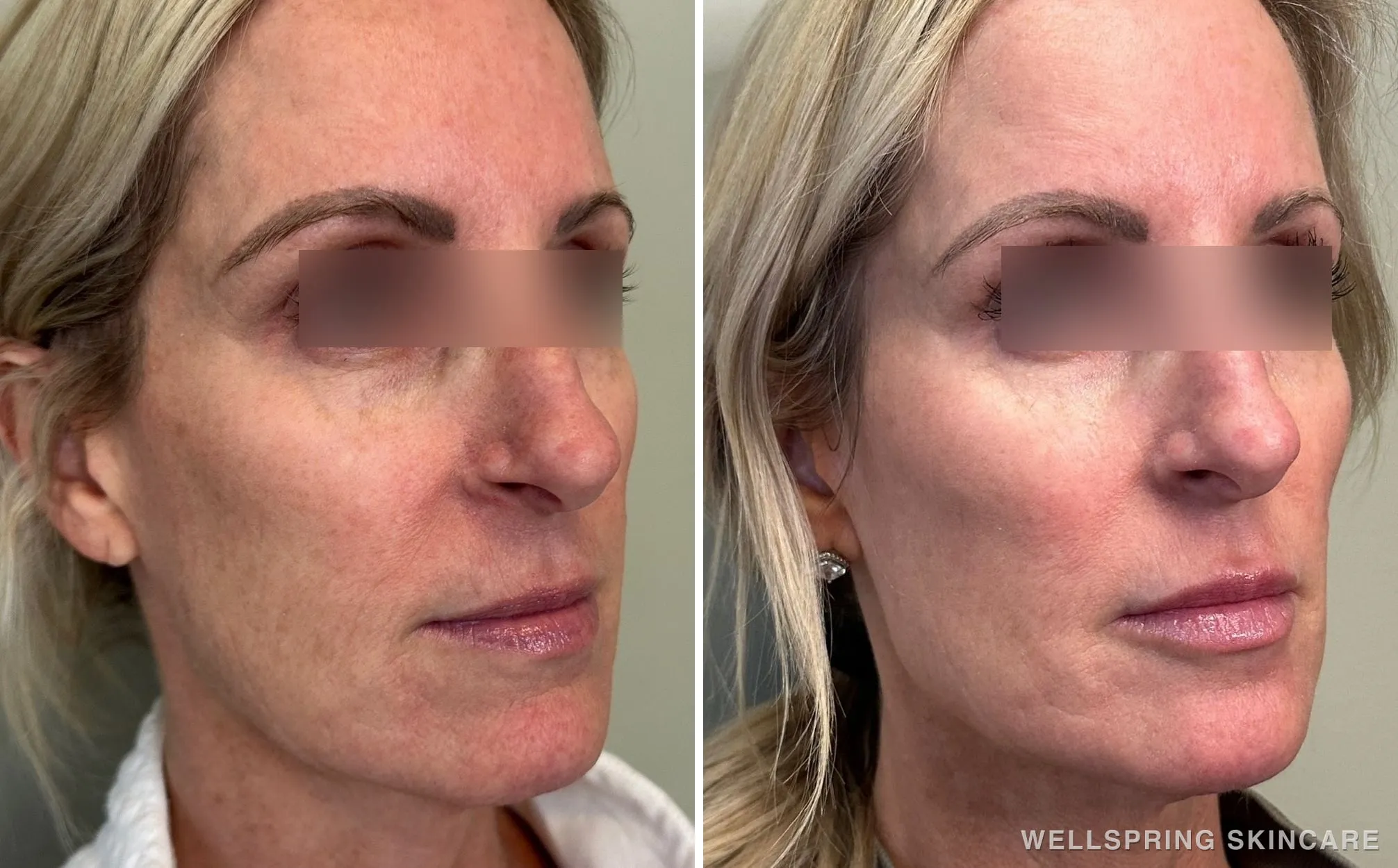 Before and after: Cheeks, smile lines & lips treated with dermal filler