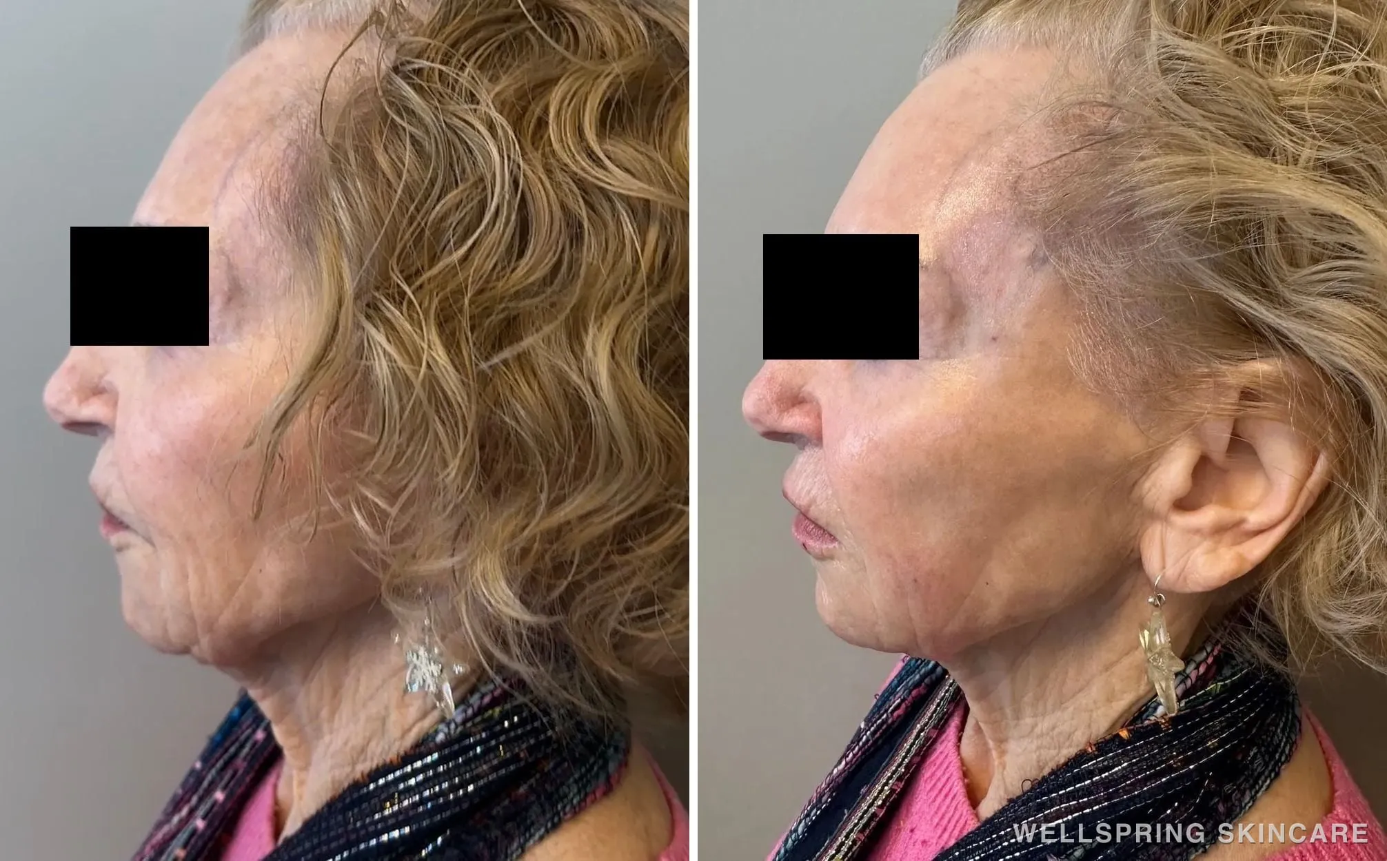 Before and after: Full face dermal filler for cheeks & jawline