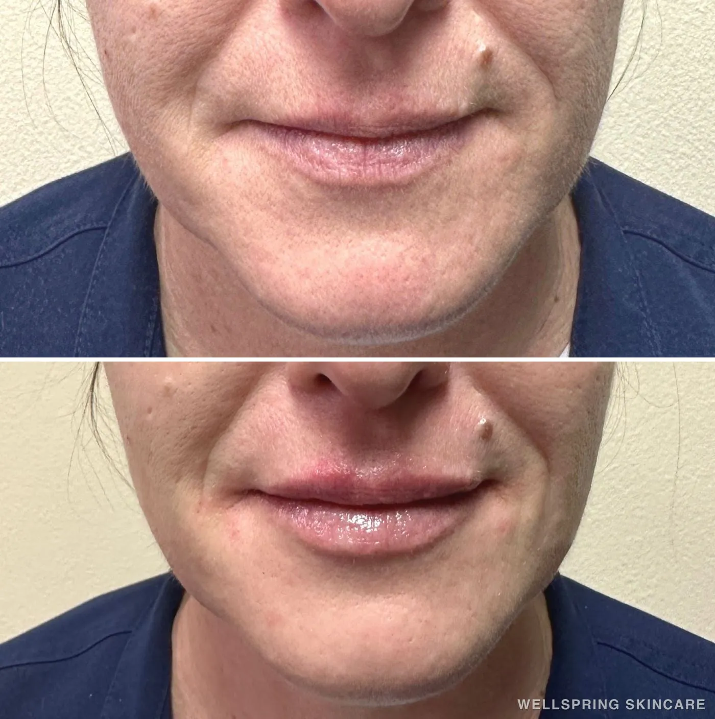 Before and after: Lip filler for fuller lips
