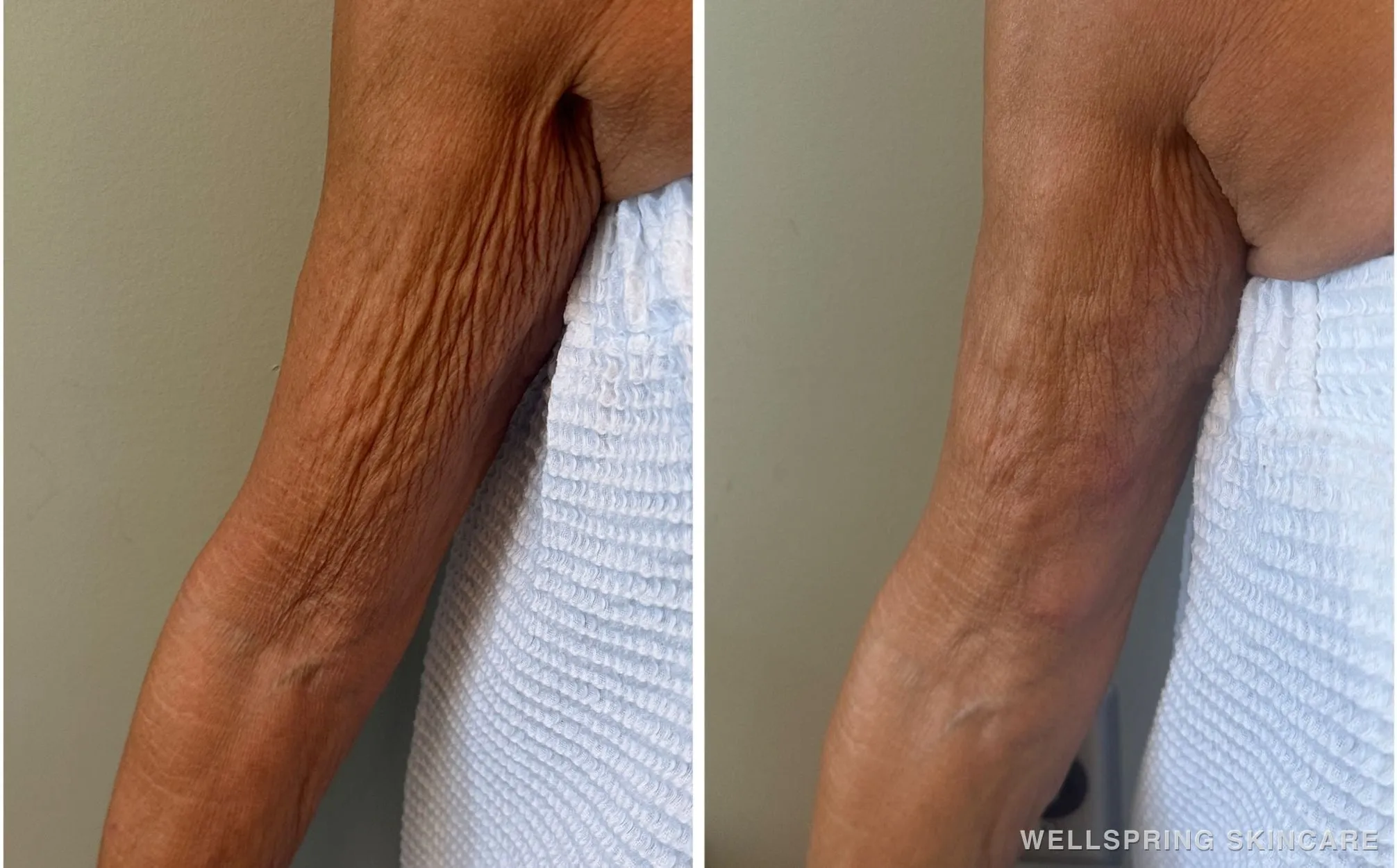 Before and after: Arm wrinkles & crepey skin treated with dermal filler