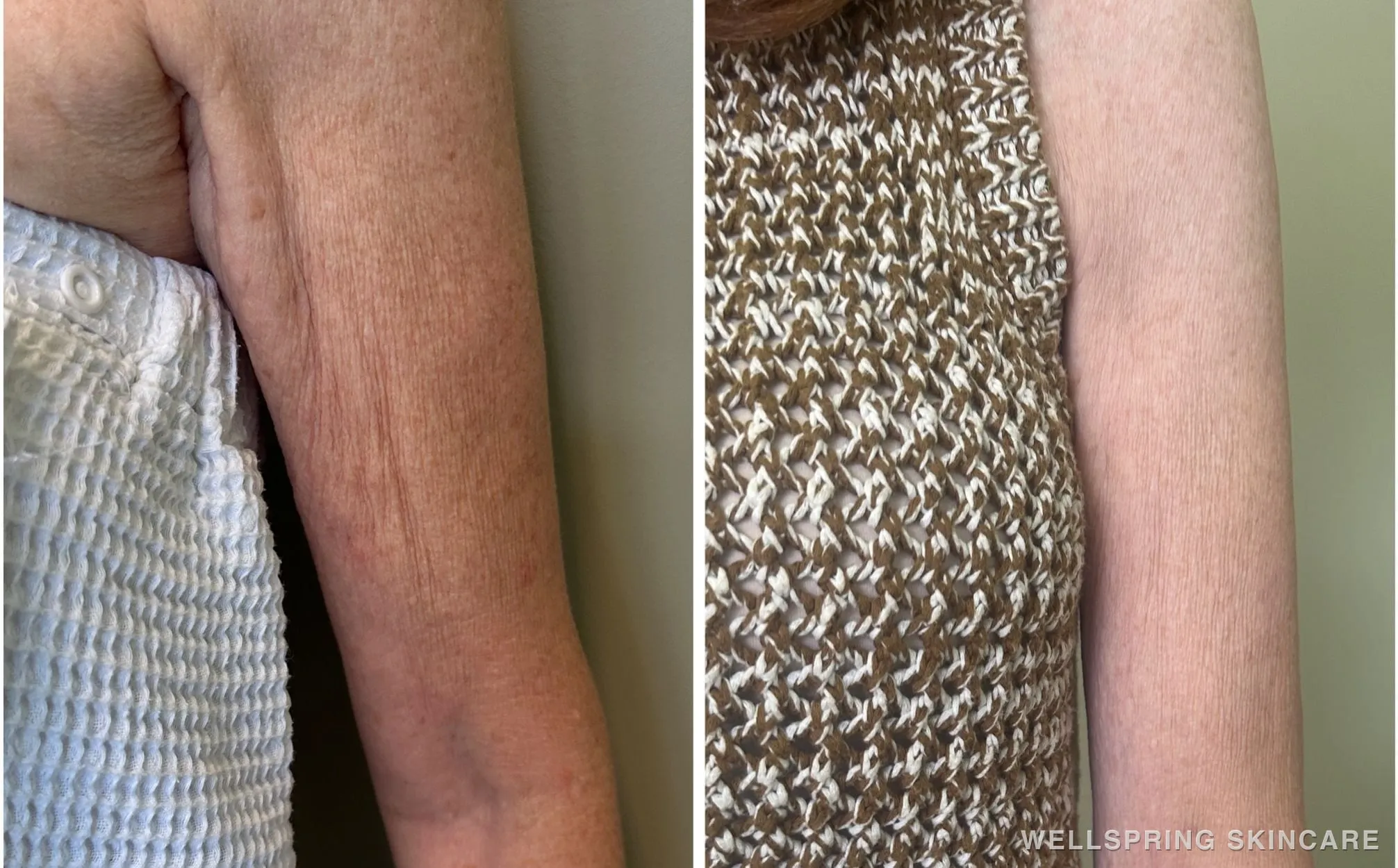 Before and after: After Dermal filler for arms