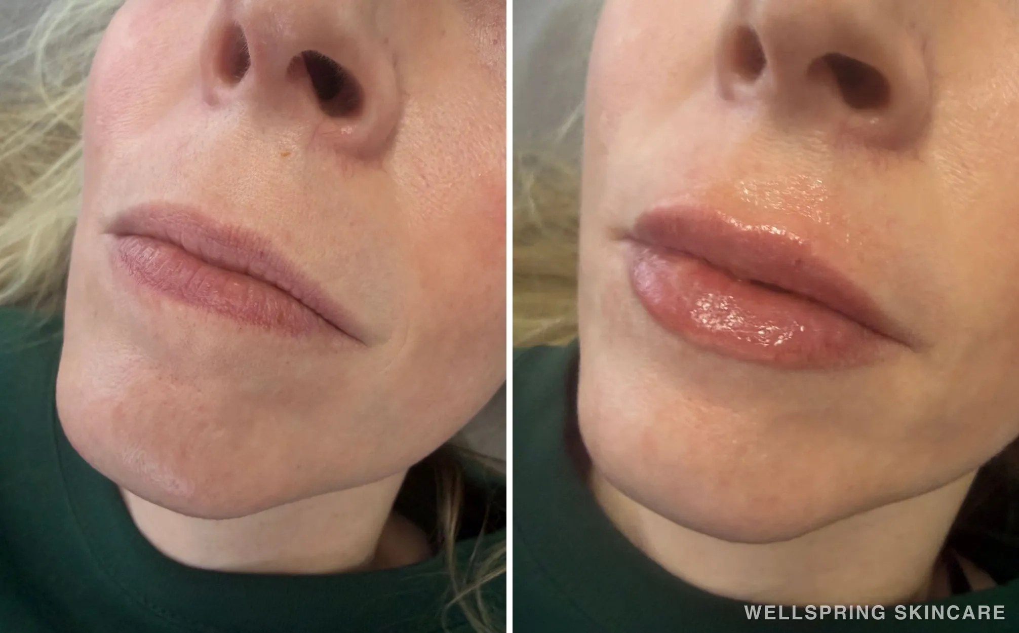 Before and after: Lips treated with lip filler