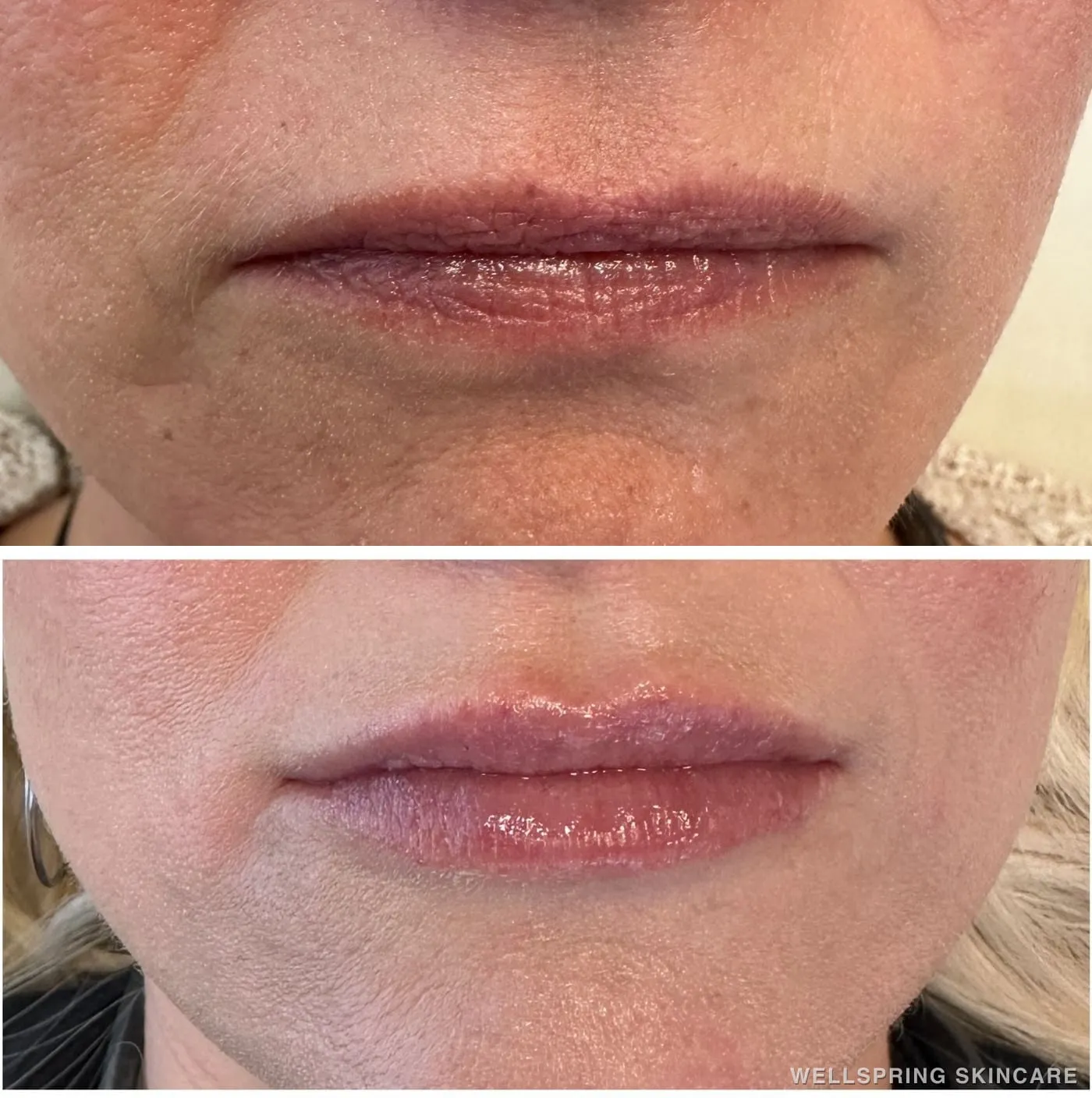 Before and after: Lip wrinkles smoothed with lip filler