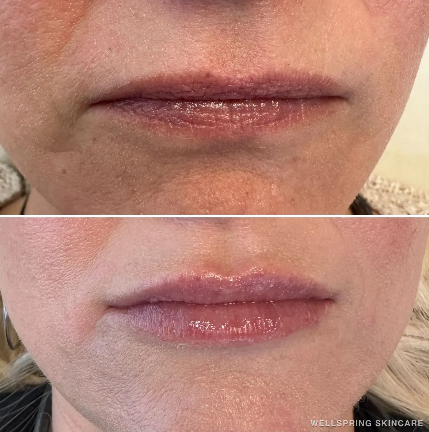 Before and after: Lip wrinkles smoothed with lip filler