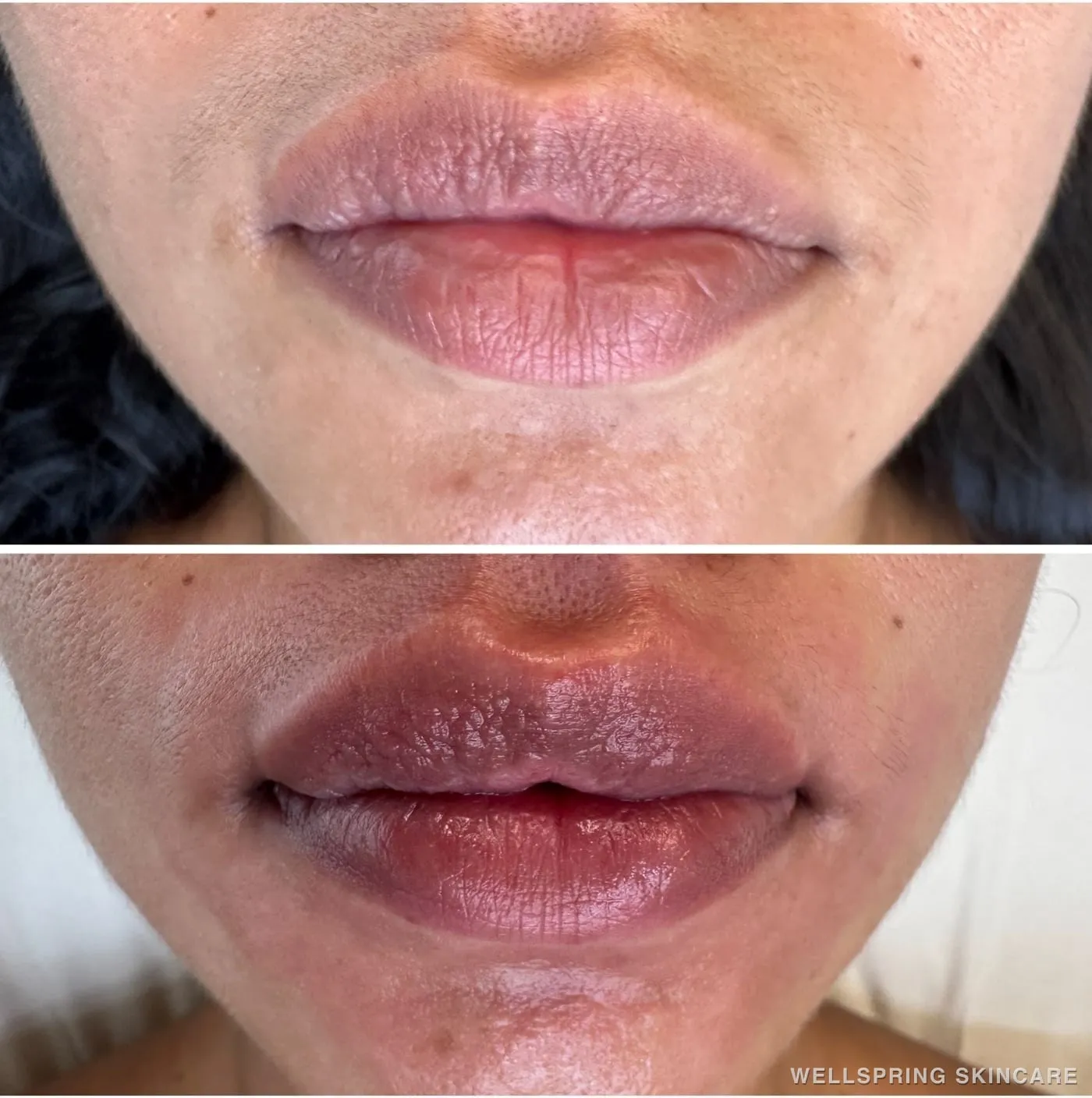 Before and after: Lips treated with lip filler
