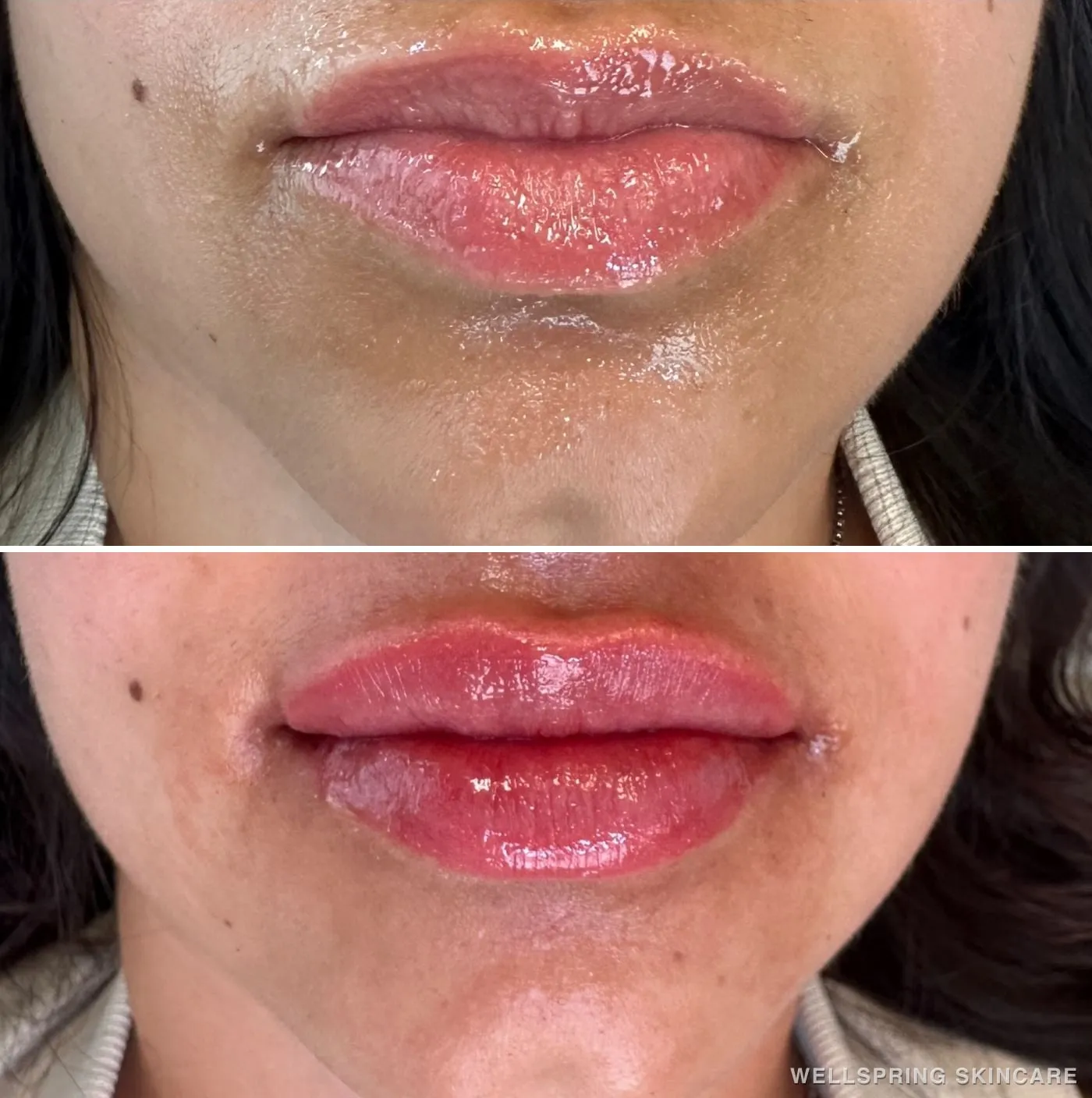 Before and after: Lip volume with lip filler