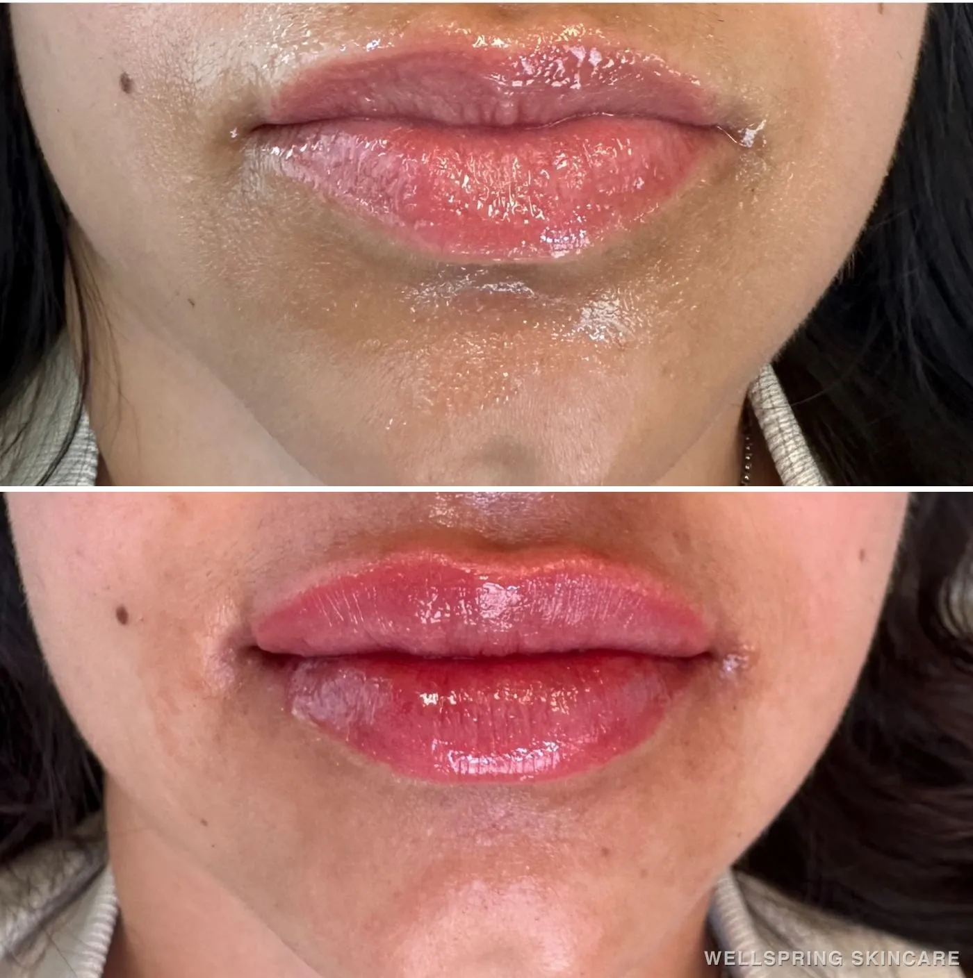 Before and after: Lip volume with lip filler
