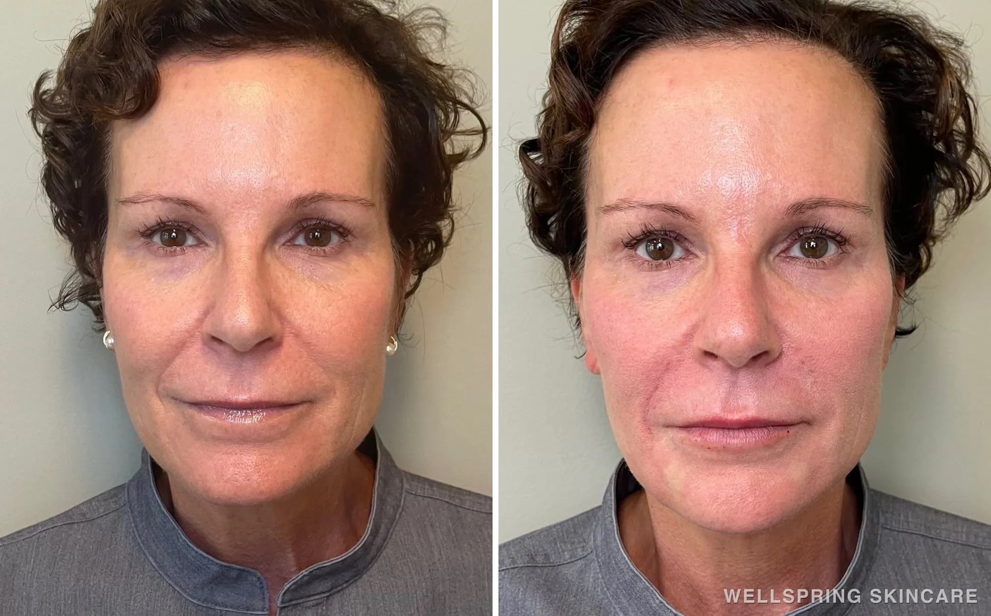 Before and after: Full face dermal filler with lip filler