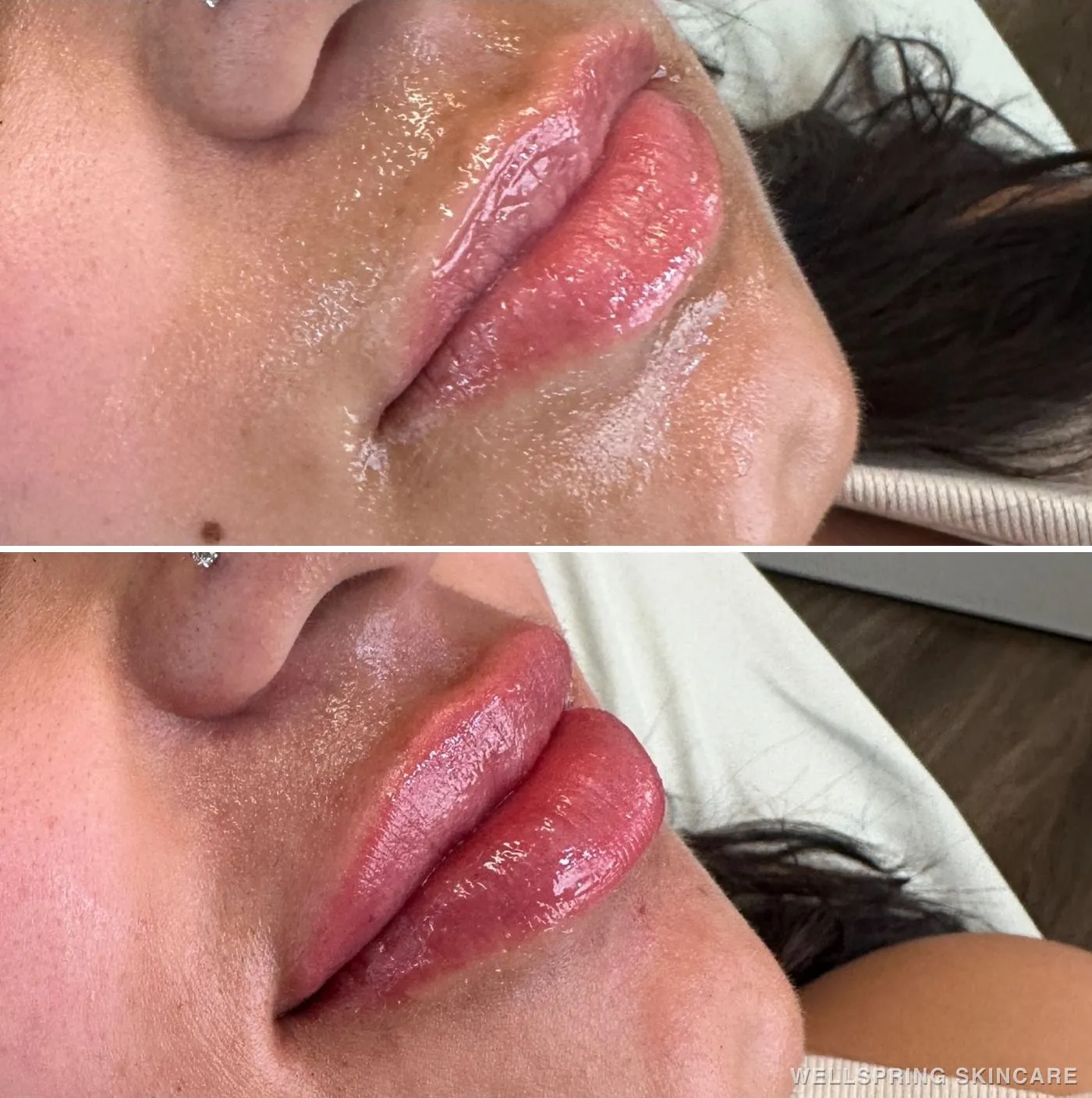 Before and after: Fuller lips with lip filler