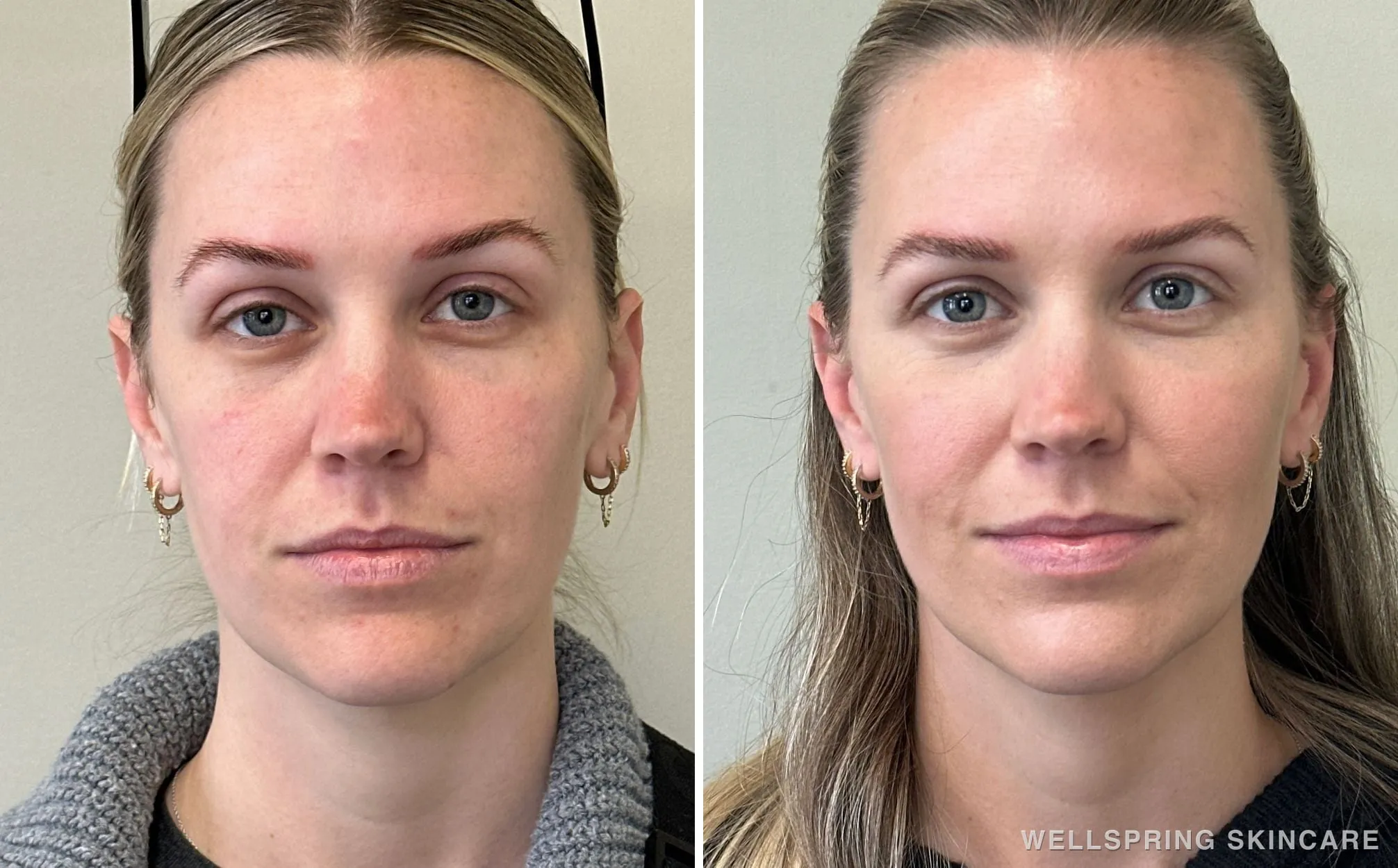 Before and after: Natural cheek volume with biostimulatory filler