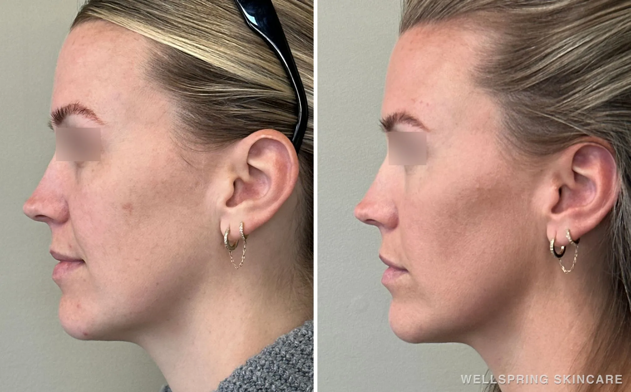 Before and after: Jawline contour with biostimulatory filler
