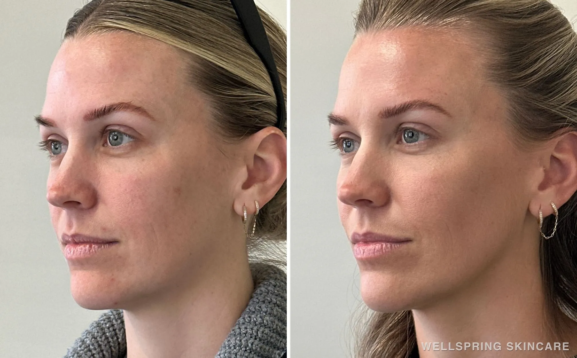 Before and after: Cheeks & jawline treated with biostimulatory filler