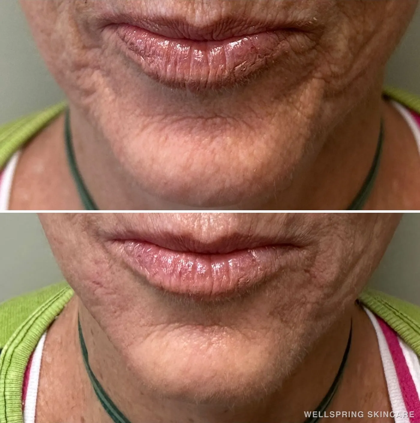 Before and after: Acne scars & texture treated with dermal filler