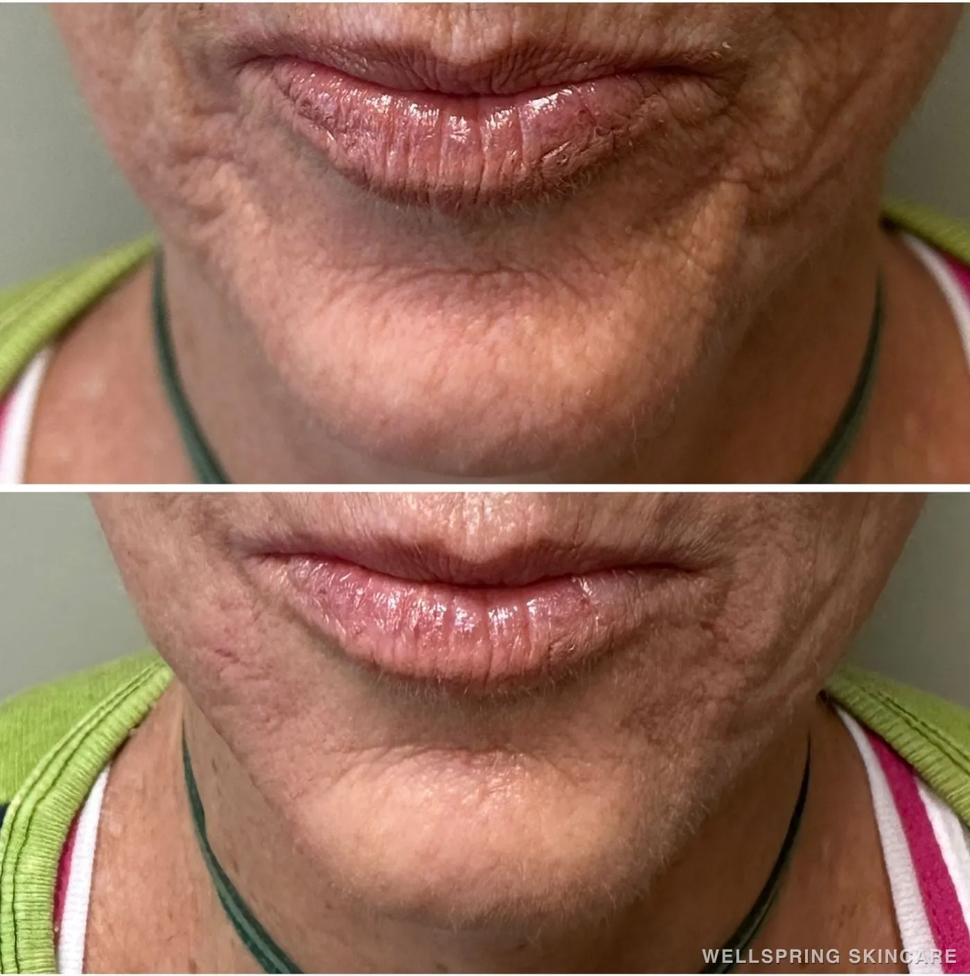 Before and after: Acne scars & texture treated with dermal filler