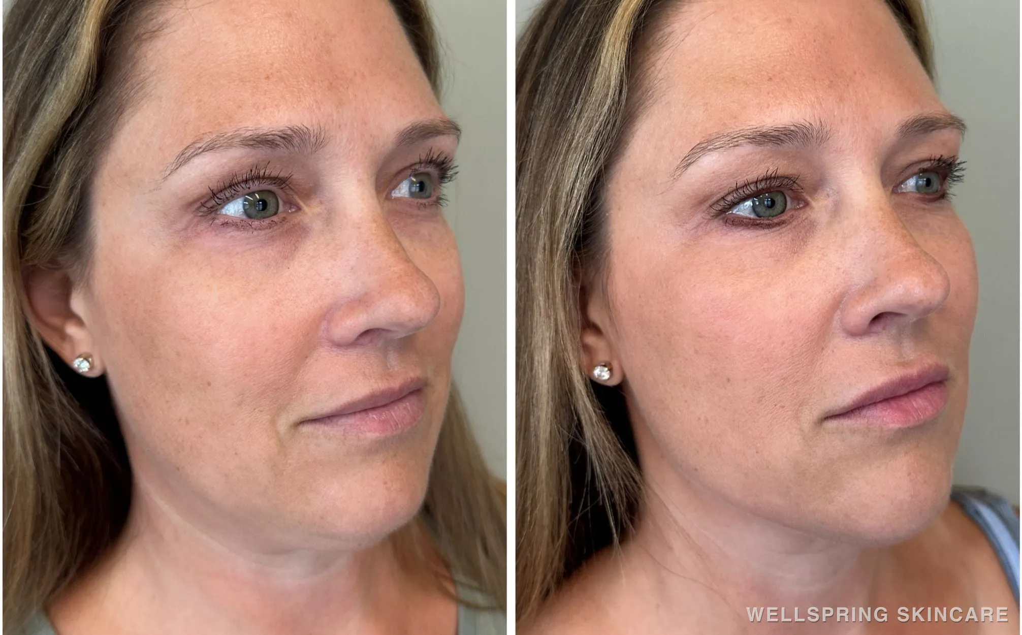 Before and after: Full face dermal filler for balanced volume