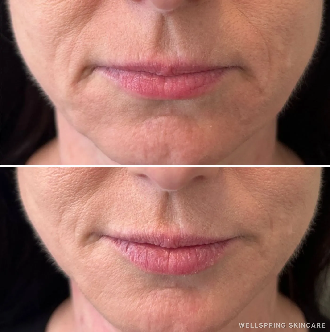 Before and after: Jowls & sagging skin treated with biostimulatory filler