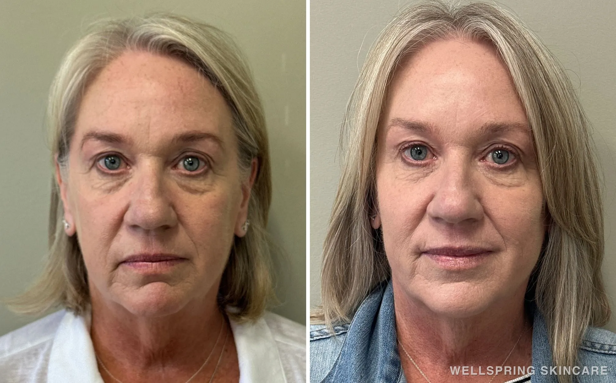 Before and after: Full face dermal filler for jowls & sagging skin