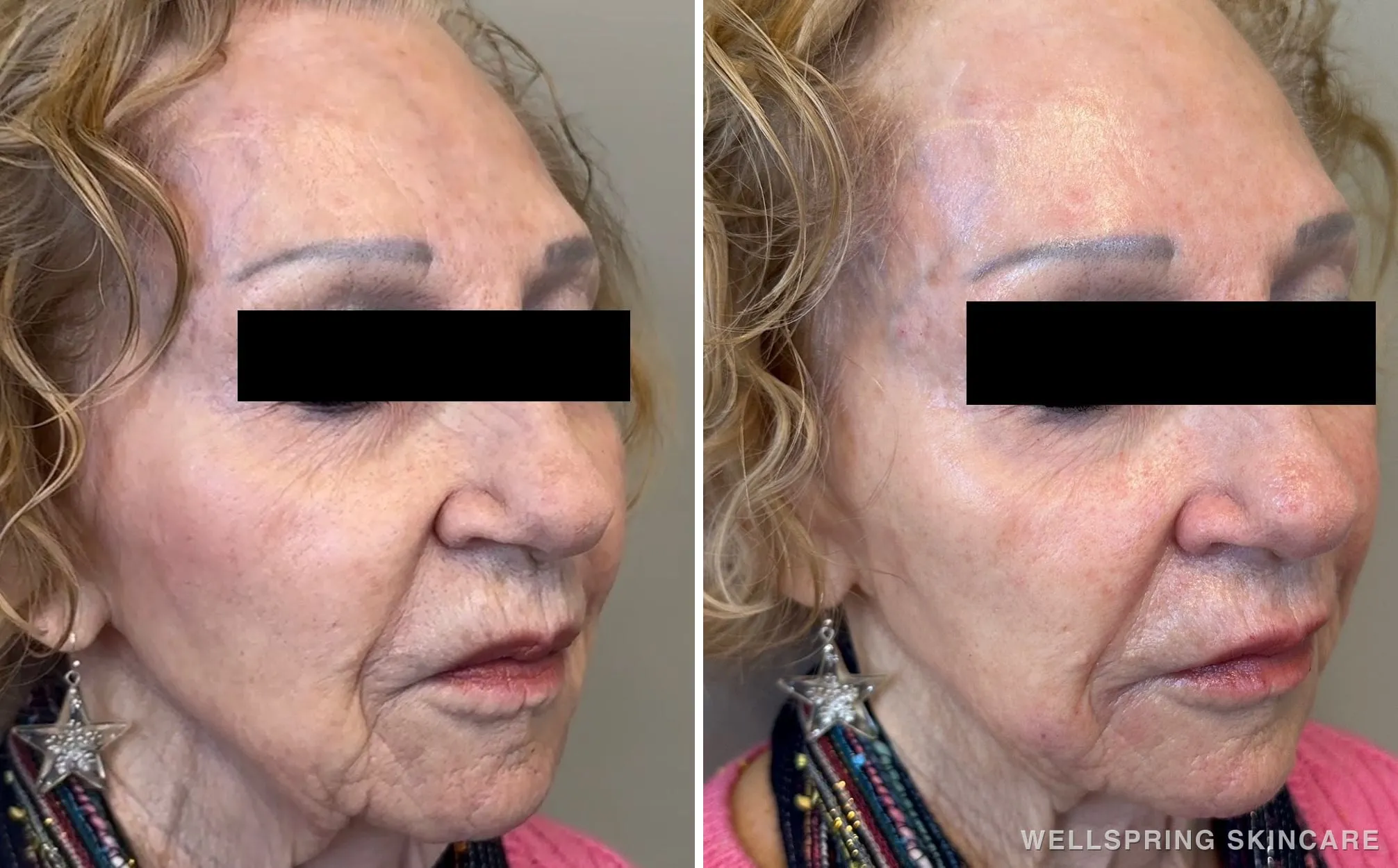 Before and after: Jowls & deep wrinkles treated with dermal filler