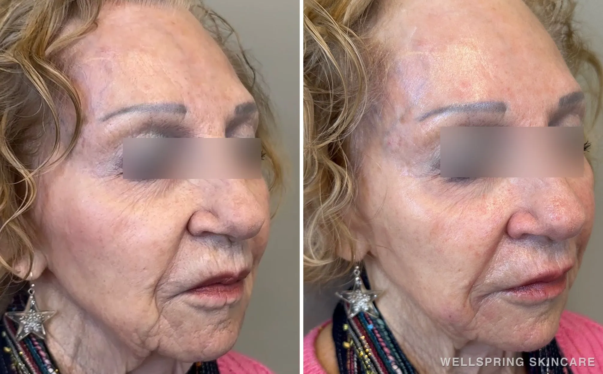 Before and after: Jowls & deep wrinkles treated with dermal filler