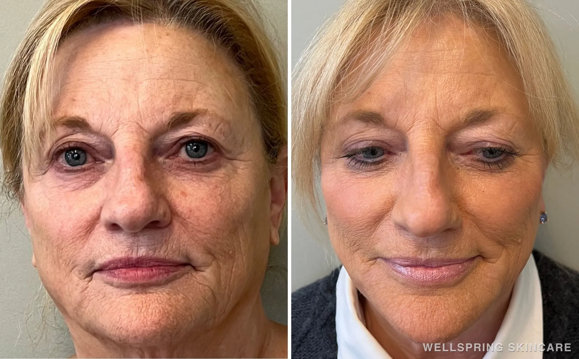 Before and after: Jowls & sagging skin treated with dermal filler & PDO threads