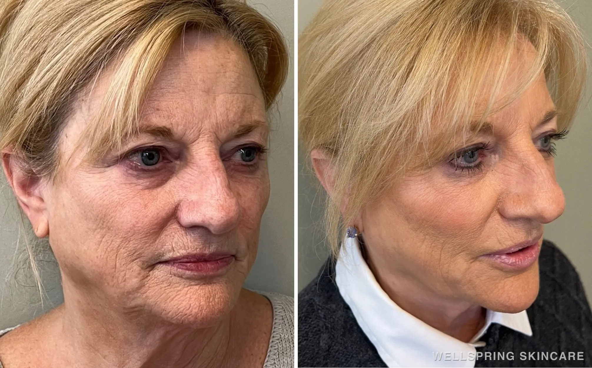 Before and after: Jowls & sagging skin treated with PDO threads & dermal filler