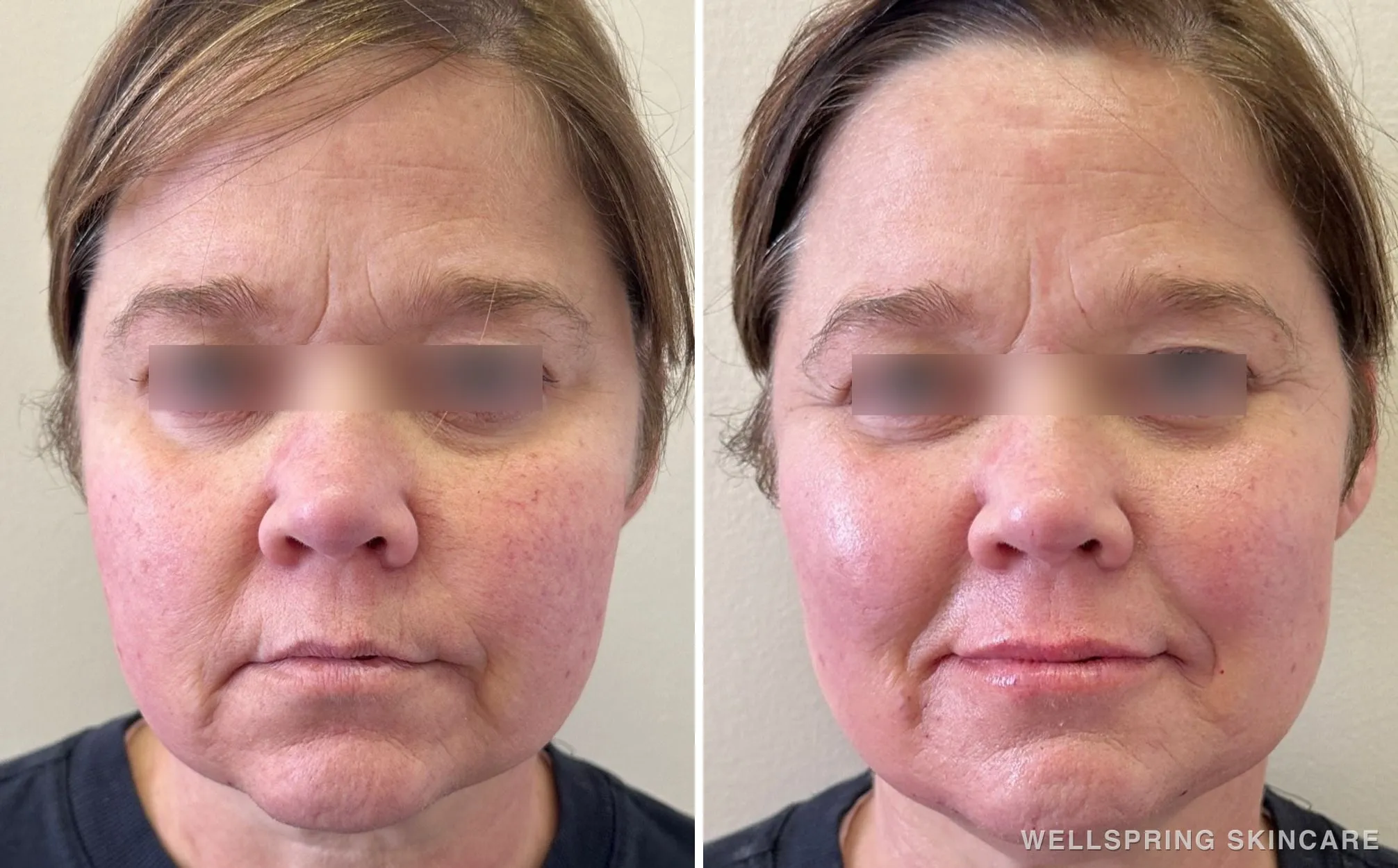 Before and after: Jowls & sagging skin treated with dermal filler