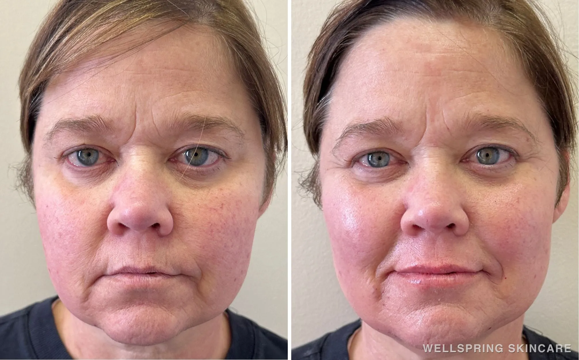 Before and after: Jowls & sagging skin treated with dermal filler