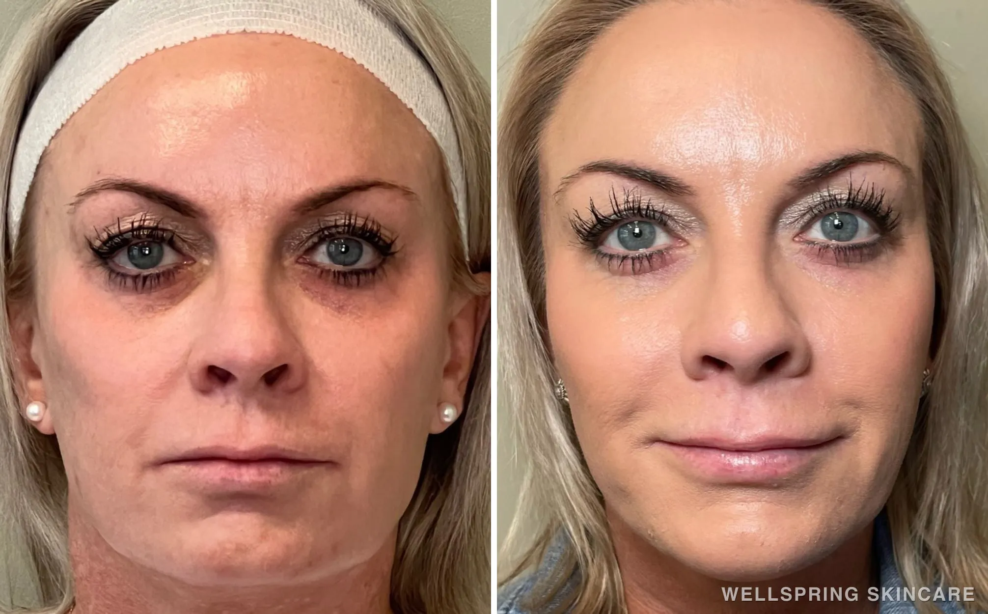 Before and after: Jowls & sagging skin treated with full face dermal filler