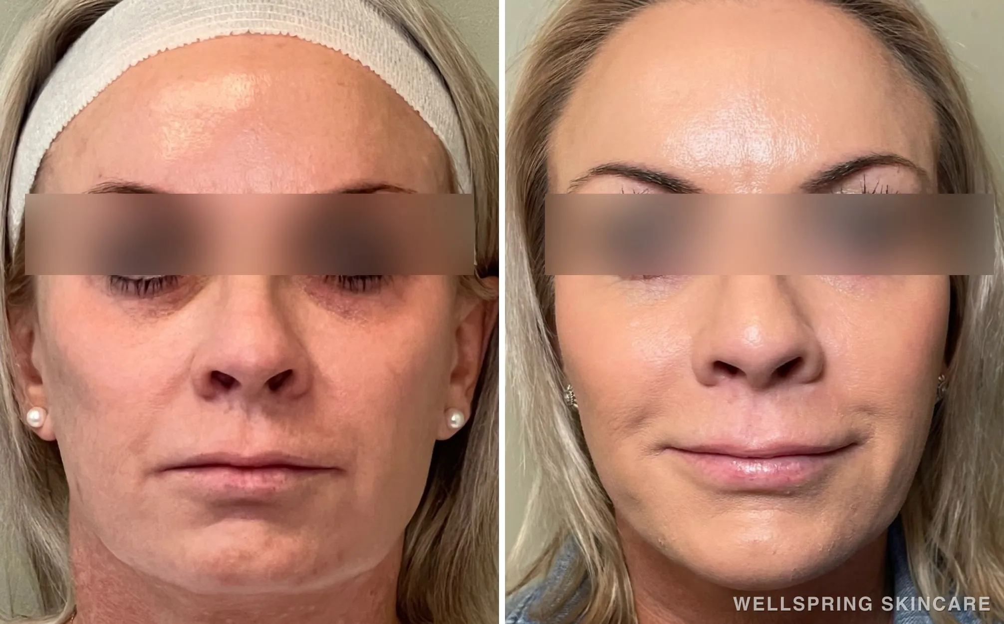 Before and after: Jowls & sagging skin treated with full face dermal filler