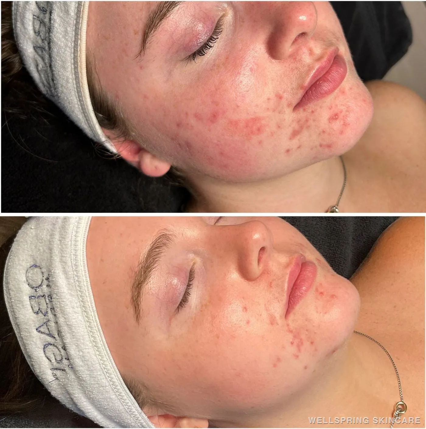 Before and after: Acne scars & texture treated with regular facials