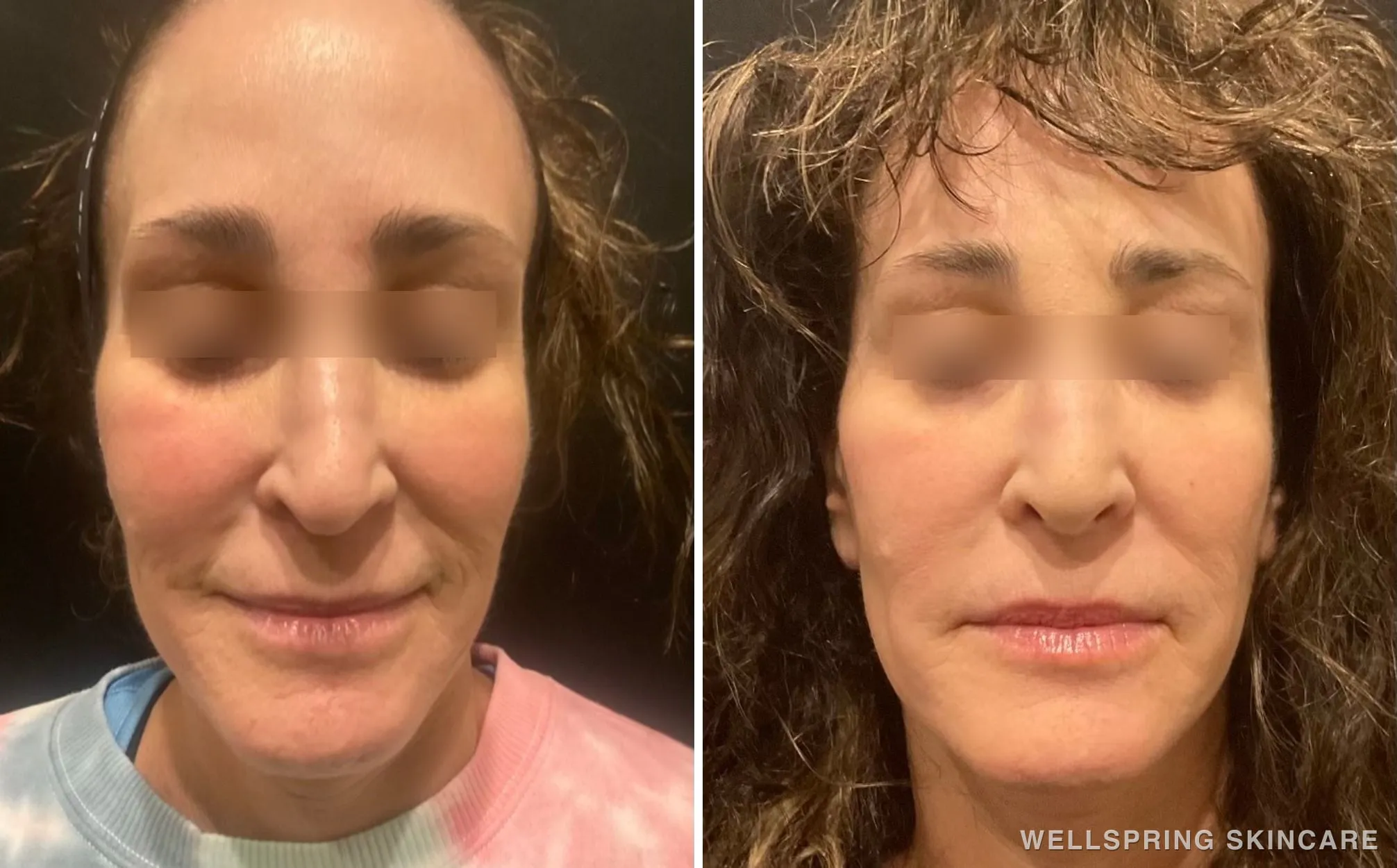Before and after: Skin tone & texture treated with Halo resurfacing