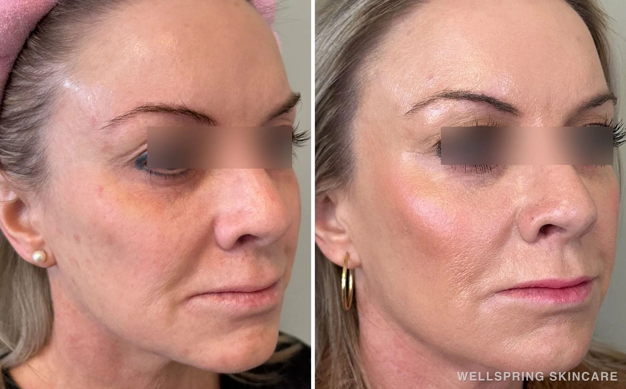 Before and after: Dull & dry skin treated with Halo