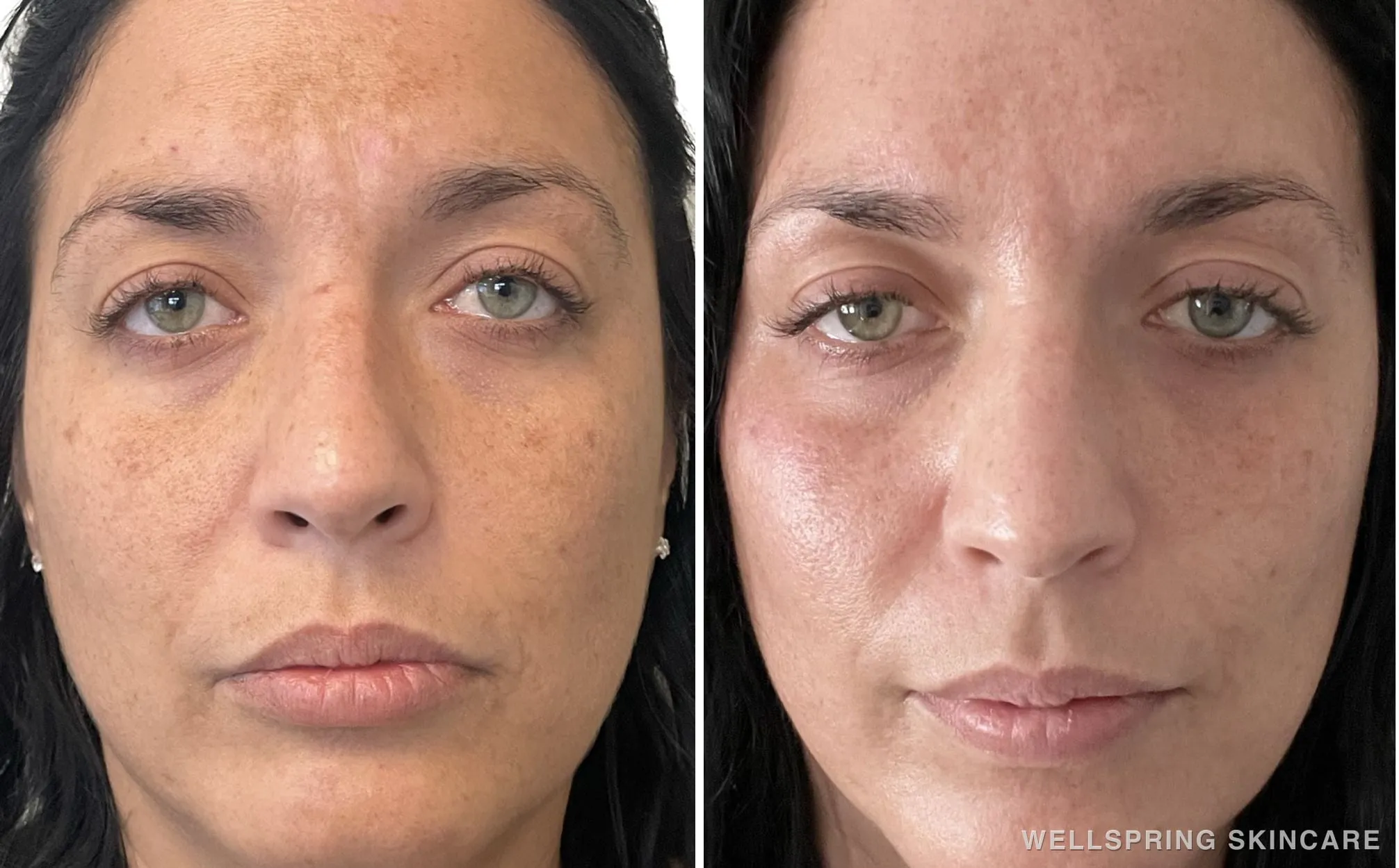 Before and after: Sun damage & brown spots treated with Halo